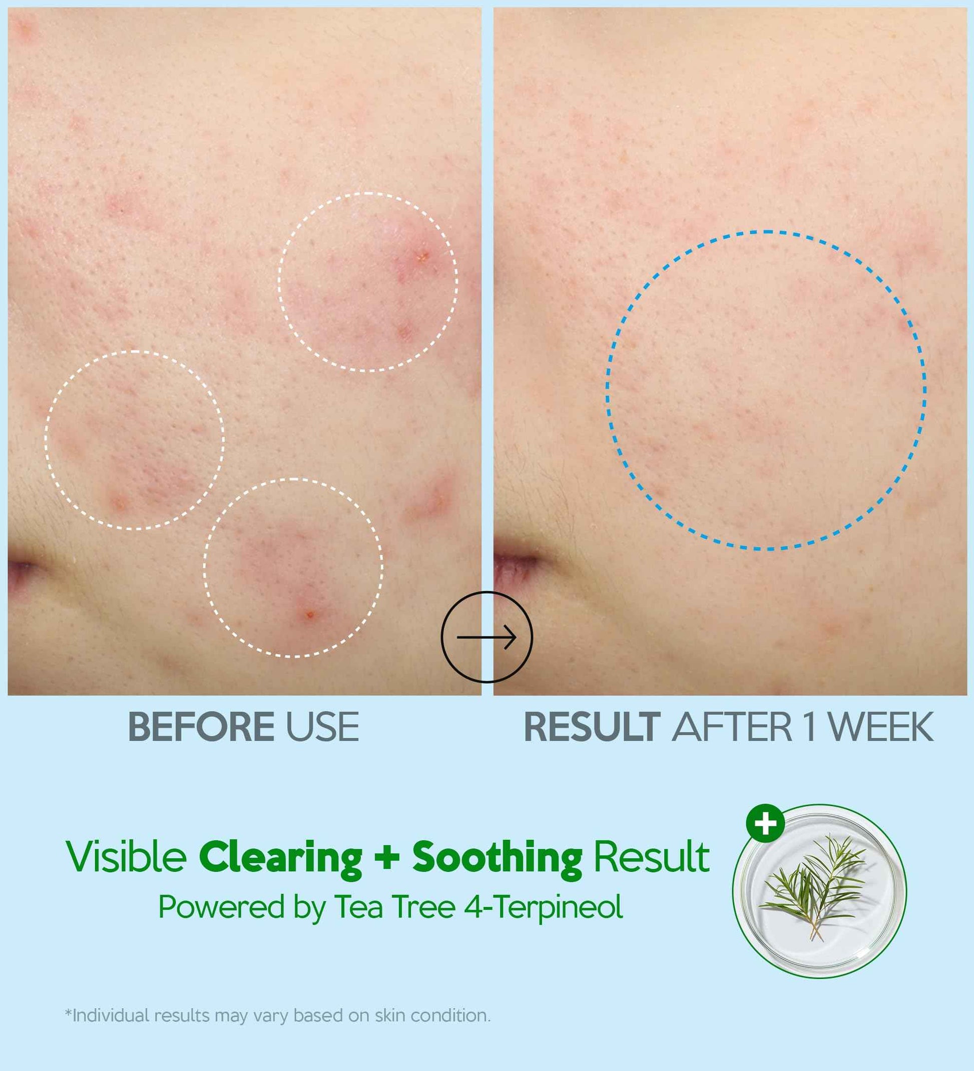 Troubless Hydro Soothing Moisture Cream - Deep Hydration & Skin Barrier Cream for Face w/ 10,000 ppm Panthenol & Tea Tree 4-Terpineol - Soothing & Non-Greasy Face Moisturizer (2.36 fl oz)