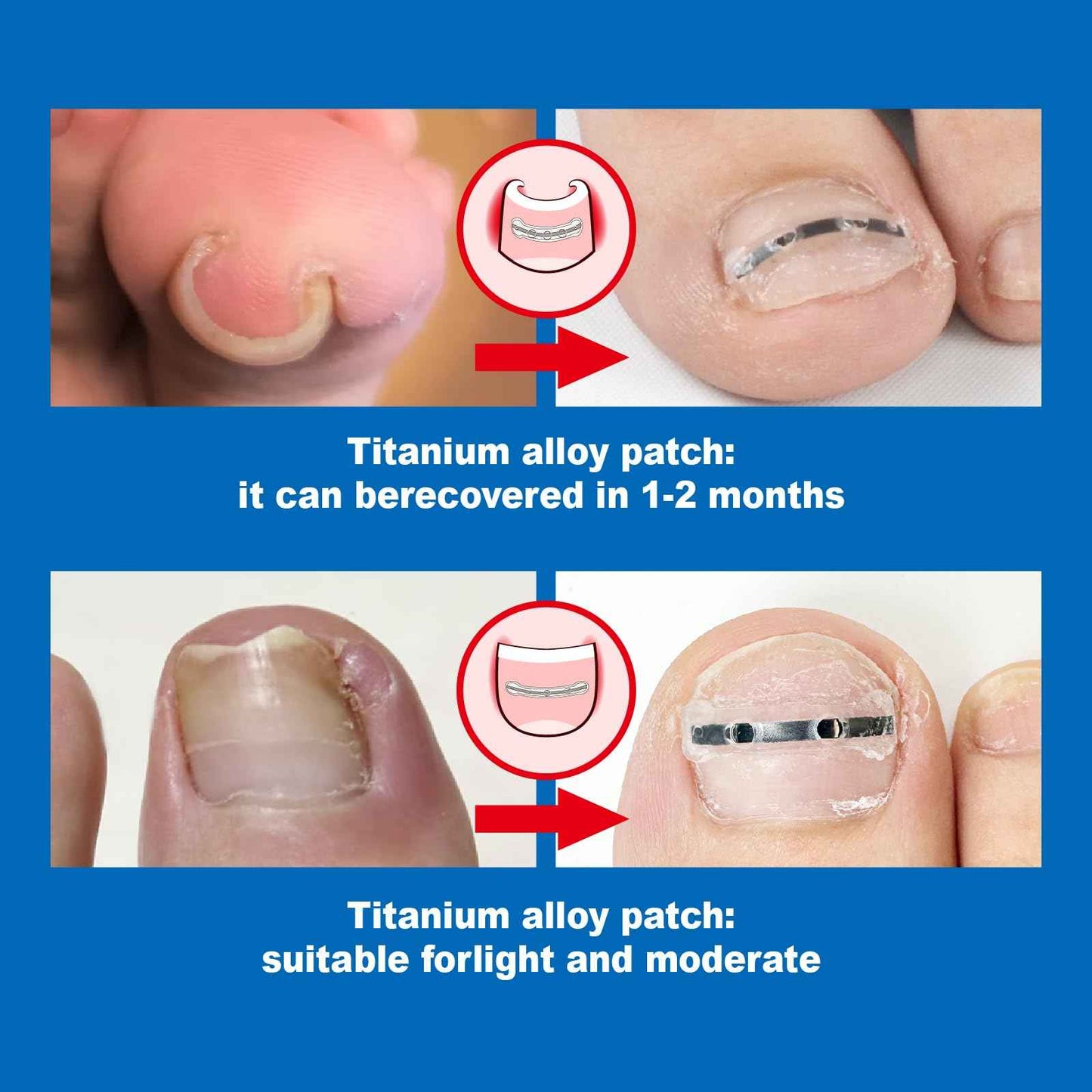 Titanium Ingrown Toenail corrector Removal Ingrown Toenail Treatment Reusable Ingrown Toenail Treatment Kit Professional Ingrown Toenailcorrection strips,Ingrown Toenail Corrector for home use 10pcs