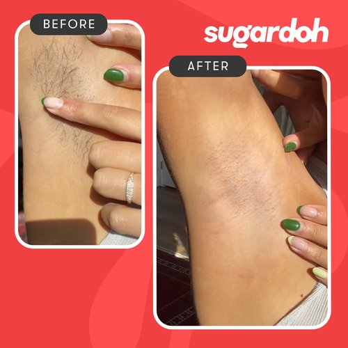Sugardoh Sugar Waxing Kit for Women As Seen On Shark Tank (Mini Kit Firm) Face, Arms, & Legs, Sugar Wax Hair Removal- Sugaring Tiktok Viral Products- Bikini Wax Kit for Women - Sugaring Kit