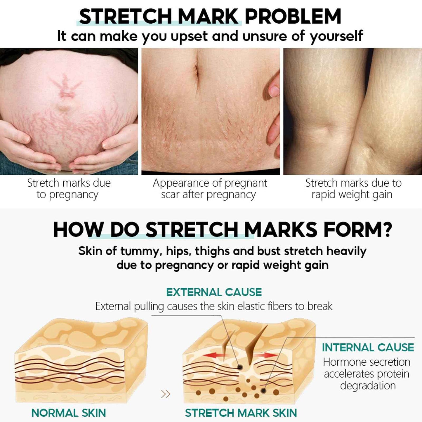Stretch Mark System, Infused with Collagen and Elastin Support – Hydrating & Nourishing Formula for Smoother Looking Skin (1)