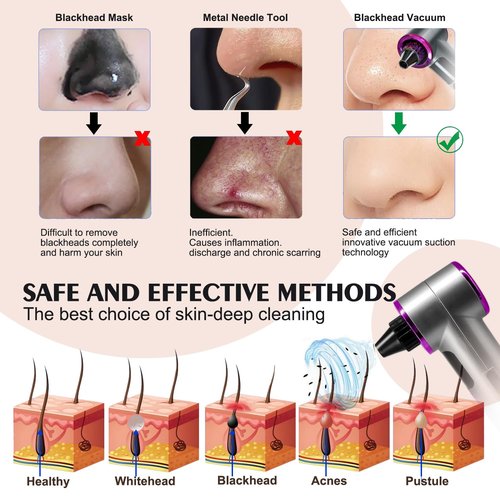 Blackhead Remover Vacuum, Facial Pore Cleaner Electric with Heating Mode, 2in1 Vacuum Pore Cleansing Tool, Electric Whitehead Remover with 9 Suction Level & 5 Heads