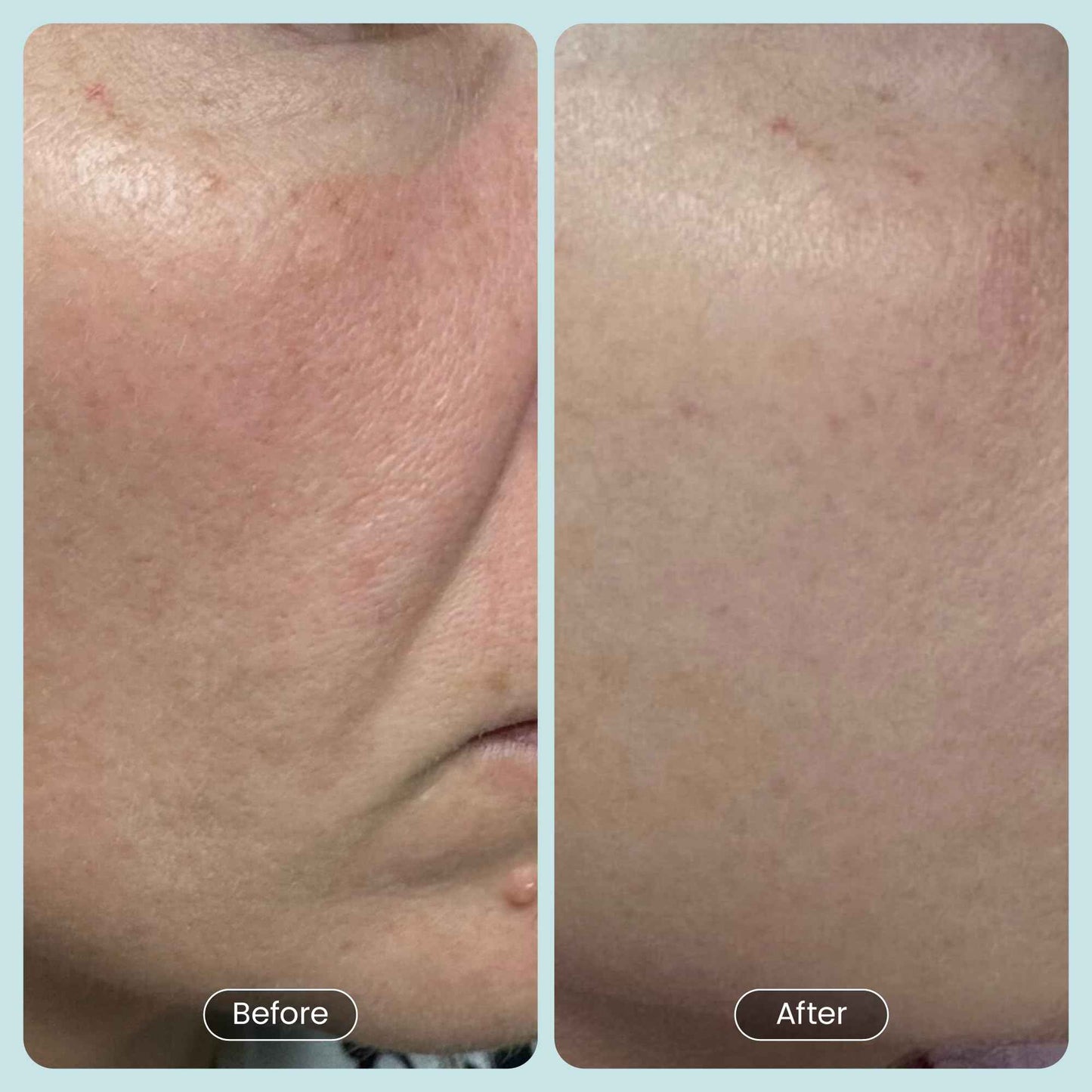 Beautiste 30 DAY MIRACLE BHA 20% Peeling Solution - Clinical Strength BHA Liquid Exfoliant for Clogged Pores, Wrinkles & Blackhead Remover - Salicylic Acid Serum & Chemical Exfoliant for Face Peel 1oz