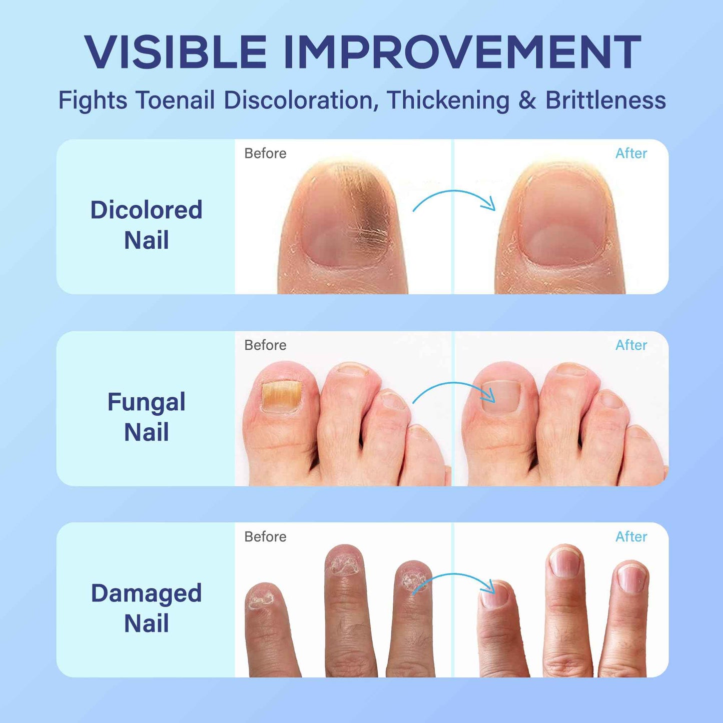 PHARMBANNER Toenail Fungus Treatment Extra Strength: 25% Undecylenic Acid Toe & Fingernail Fungus Renewal - Nail Fungus Treatment Kit with Brush & File - For Ingrown Nails & Discoloration