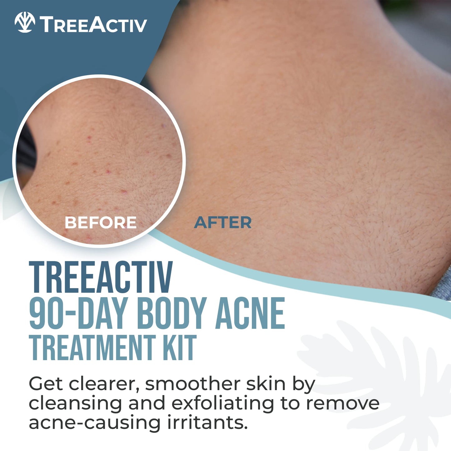 TreeActiv 90-Day Body Acne Treatment Kit, Salicylic Acid Acne Body Spray, Exfoliating Body Acne Wash, Body Acne Treatment for Back, Chest and Butt Acne Removal, Back Acne Treatment For Women and Men