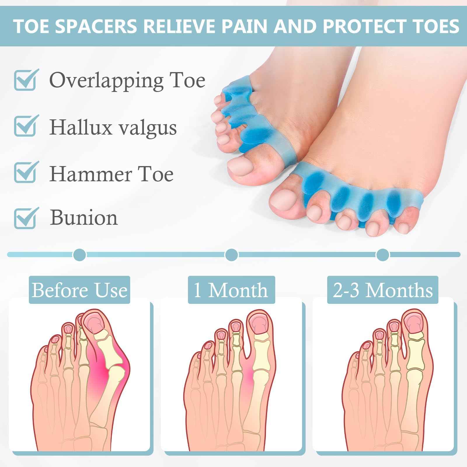 sundpik 2PCS Toe Separators for Women and Men, Gel Toe Spacers for Pedicure and Foot Alignment, Comfortable Foot Care for Bunions and Overlapping Toes