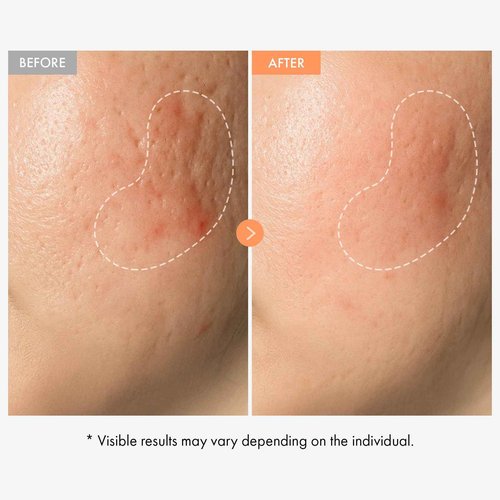 NATUREKIND Niacinamide Vitamin Ampoule - 20,000ppm Vitamin B3 Concentrated Serum, Panthenol, Hydrating, Fine Lines, Post Acne Marks, Uneven Skin Tone & Dull Skin, Korean Skin Care, 100ml, 3.38 fl.oz.