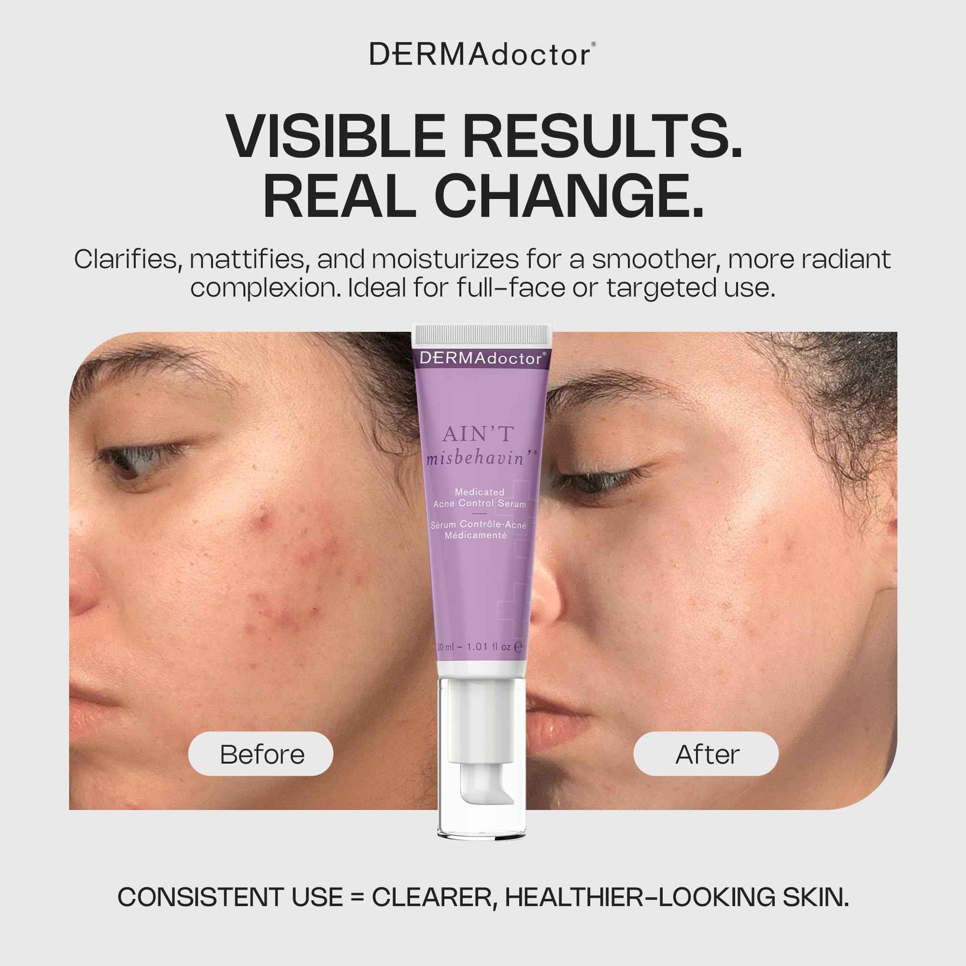 DERMAdoctor Ain't Misbehavin' Dermatologist Formulated Salicylic Acid Acne Control Serum, Acne Spot Treatment for Blemish Control and Cystic Acne breakouts with Tea Tree - 1 oz