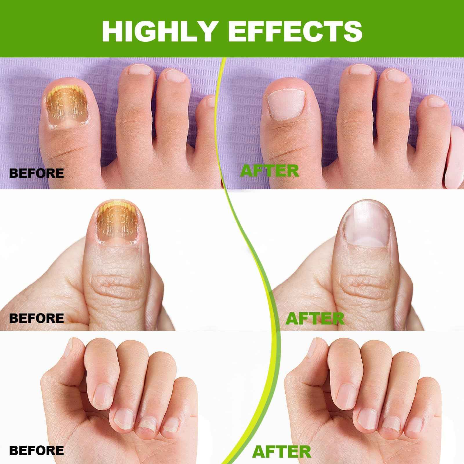 Multifunctional Equipment Blue Device for Toenails and Fingernails, Damaged and Discolored Effective & Reliable