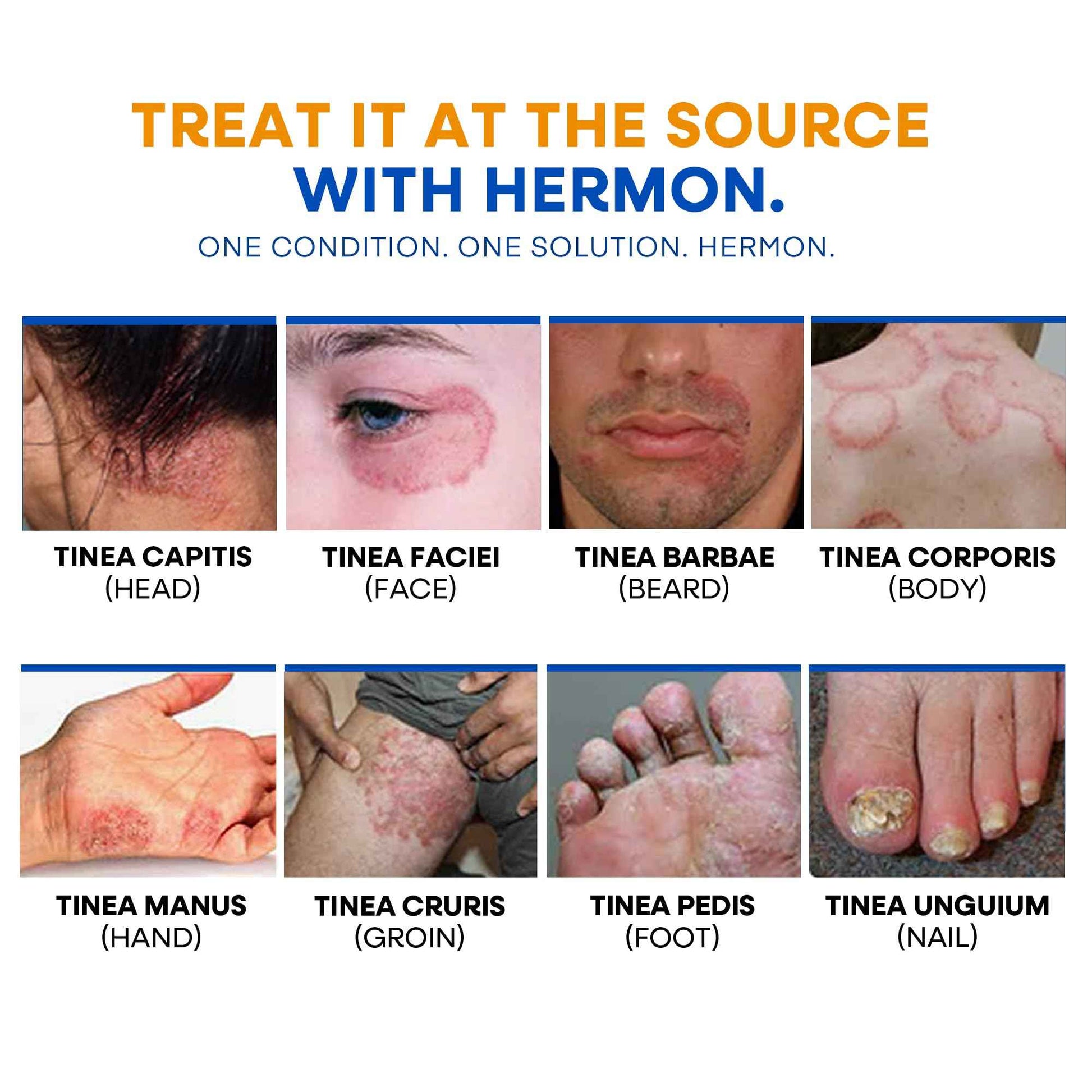 Hermon Ringworm Treatment Anti-fungal Kit - RingWorm Treatment for Humans 3.52 oz cream 4 oz soap bar for Ringworm, Athlete's Foot, Jock Itch, Eczema, Tinea - for Adults and Kids