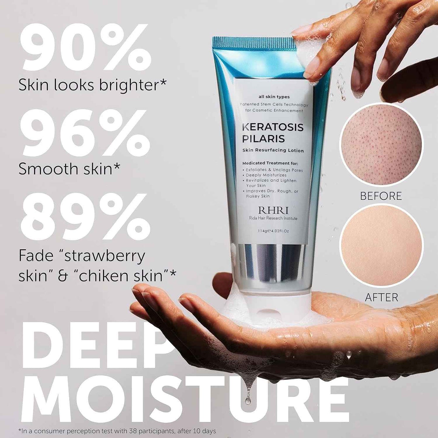 KP Bump Eraser Body Scrub | Keratosis Pilaris Treatment | Bump Eraser Body Scrub | Exfoliating Body Scrun | Ingrown Hair Treatment | Clears Strawberry Legs | Soothes Redness, Dryness & Flaky Skin