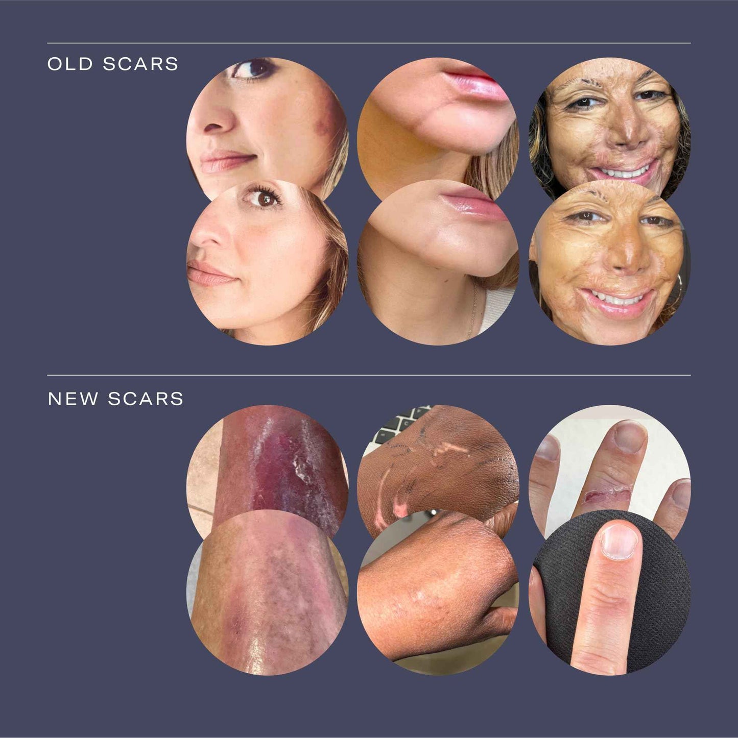 ESTAS Beauty Scar Cream On The Go -Daily Vitamin E & C with Silicone, For Old & New Scars on Face & Body, Ideal For Surgical, Burn, C-Section & Acne Scars, Vegan + Cruelty Free, (0.17oz pack of 3)