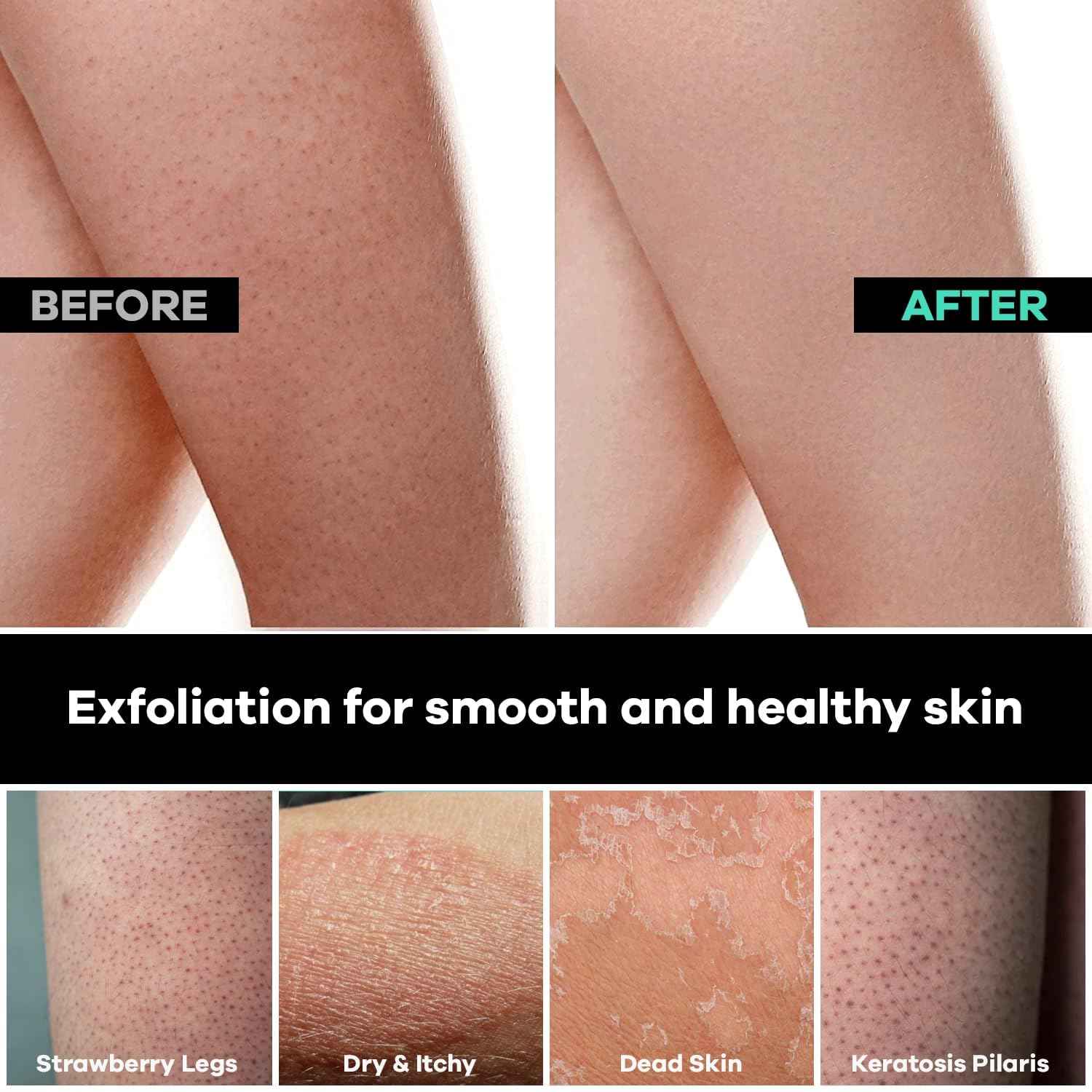 Dermasuri - Deep Exfoliating Body Mitt & Back Scrub Bundle - Bath & Shower Body Scrubs - Cleansing & Full Body Exfoliation - Spa Exfoliator Glove - Dry Skin Care Treatment for Women & Men