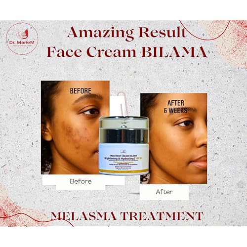 FACE CREAM BIL?MA Brightening & Hydrating Treatment Cream ? Melasma & Dark Spot Corrector with Azelaic Acid, Niacinamide & Glutathione ? SPF 30 ? 50 ml / 1.67 fl oz