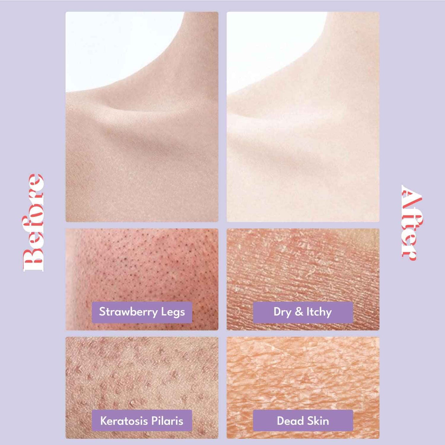 Toi:L Gentle Touch Bubble Peeling Body Pad(5pads), Body Scrub, Exfoliating Mitt for Body, Exfoliating Gloves, washcloth, Body loofah, Dense Bubble Bath, Bath Shower, kp Bump Eraser, Stocking Stuffer