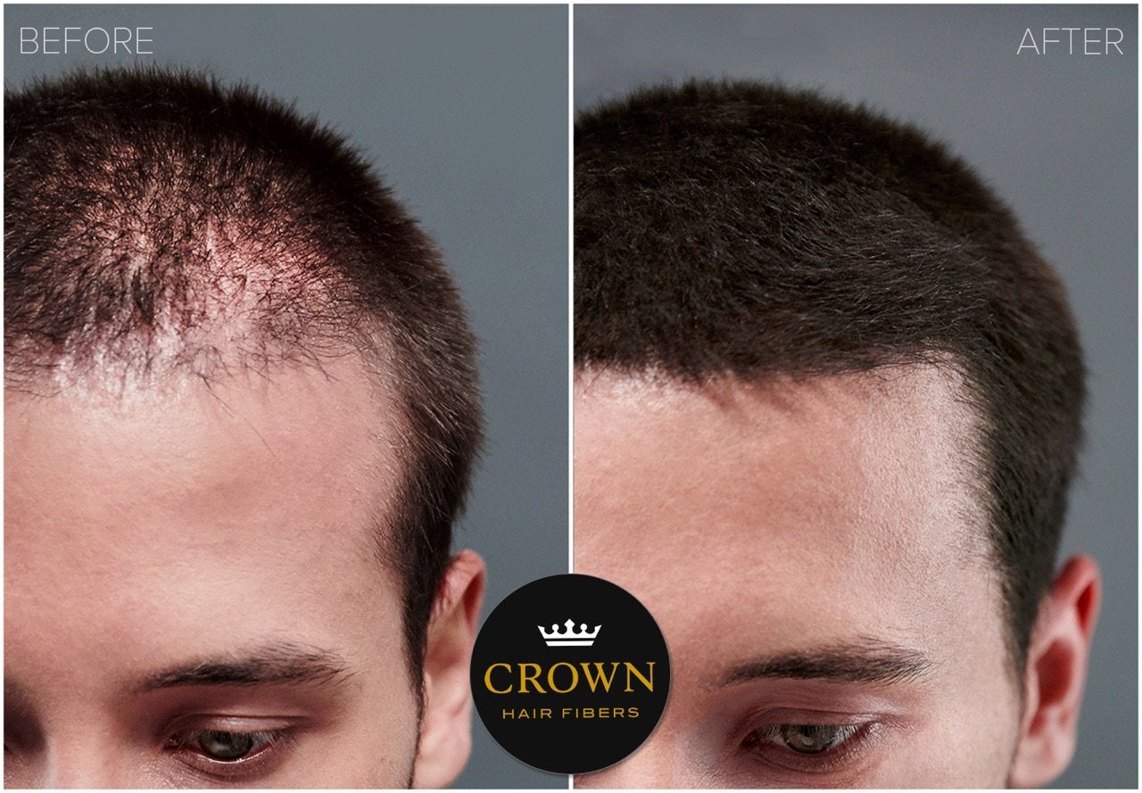 CROWN HAIR FIBERS for Thinning Hair (BLACK) - Instantly Thickens Thinning or Balding Hair for Men & Women - 0.87oz/25g Bottle - Best Natural Keratin Hair Loss Concealer