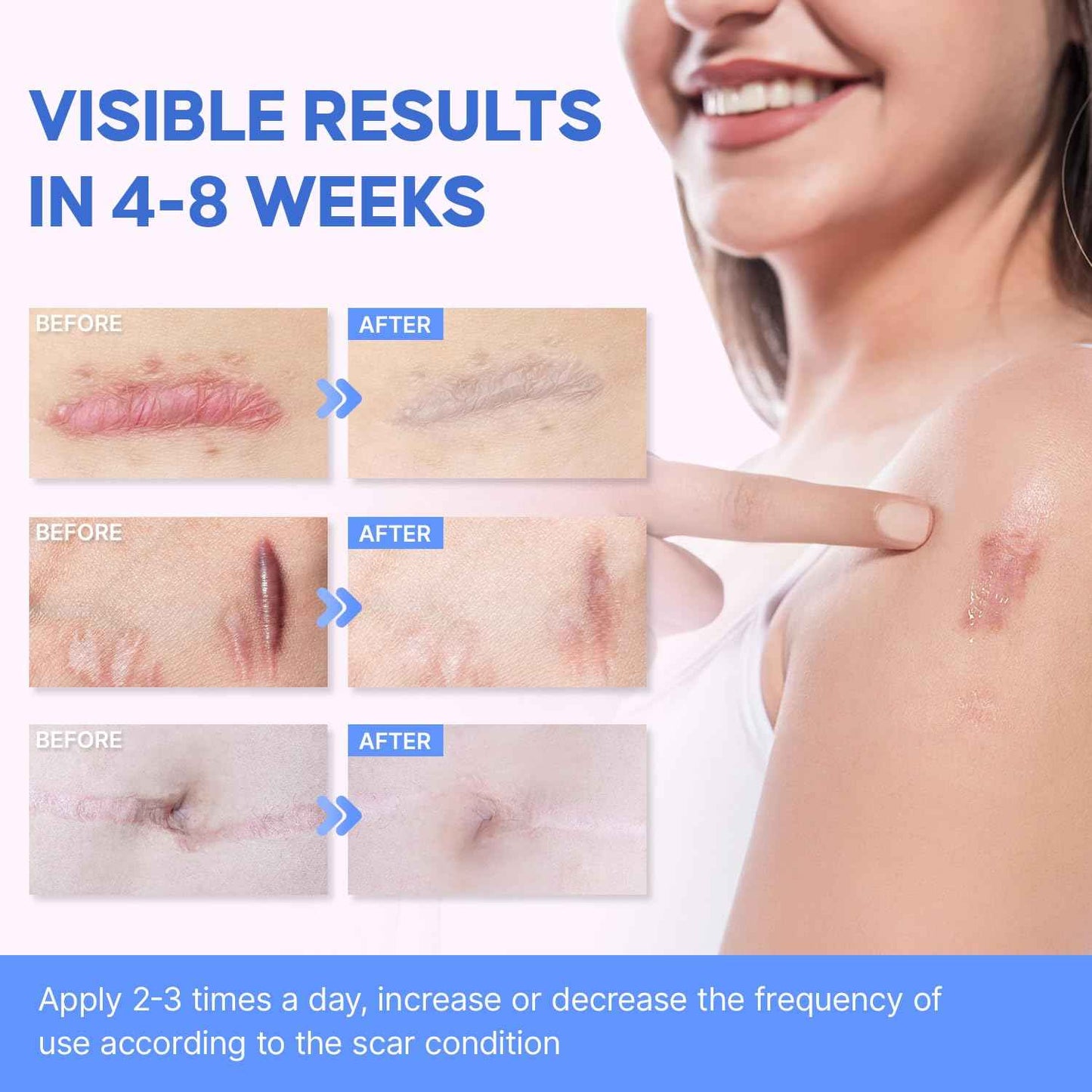 Medical Grade Silicone Scar Gel: Old and New Scars Removal Cream - Intensive Fade Surgical & C-Section Scars, Stretch & Acne Marks, Injury, Burns, Keloids, 30g, 2 Scar Sheets