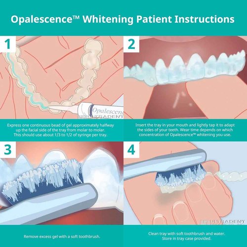 Opalescence 35% CP Mint - Gel Syringes Teeth Whitening - Refill Kit (4 Syringes) Carbamide Peroxide Gel. Made by Ultradent. Tooth Whitening Refill Syringes with Toothbrush. 5197-2tb