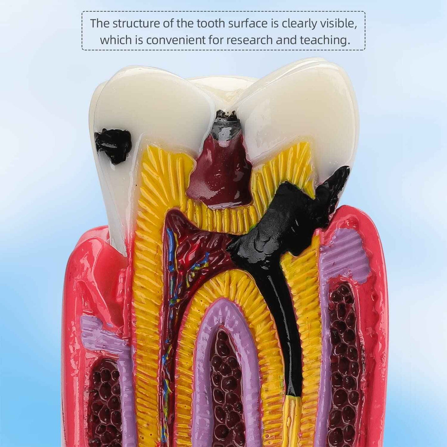 faruijie Dental Caries Tooth Model - 6 Times Caries Anatomy Dental Care Teeth Model Decay Teeth Comparative Education Model Dental Model Teaching for Patient Education