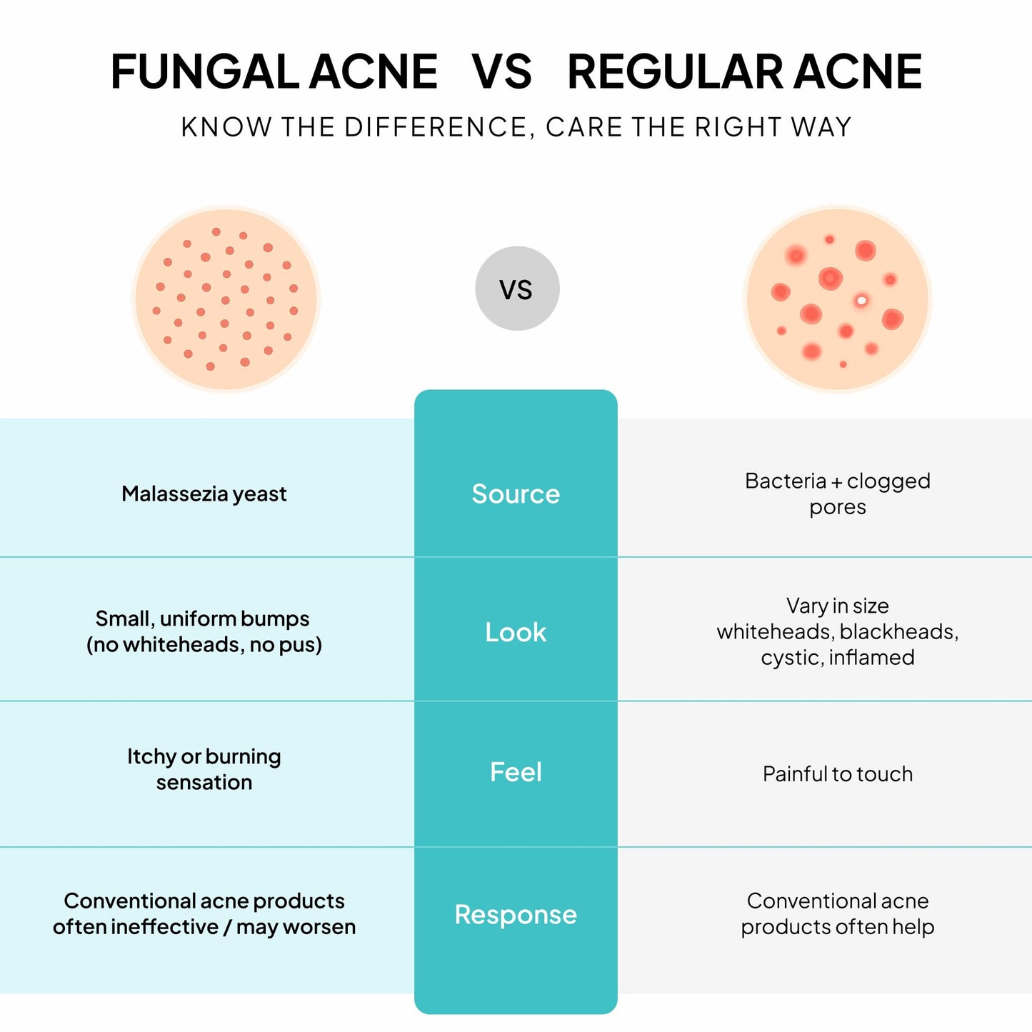 BellamiLuxx Fungal Acne Treatment Lotion: Effective Face & Body Pimple Cream for Bumps, Clusters, Itch & Redness – Fungal Prone Skin Acne Treatment Moisturizer for Teens & Adults with Natural Actives