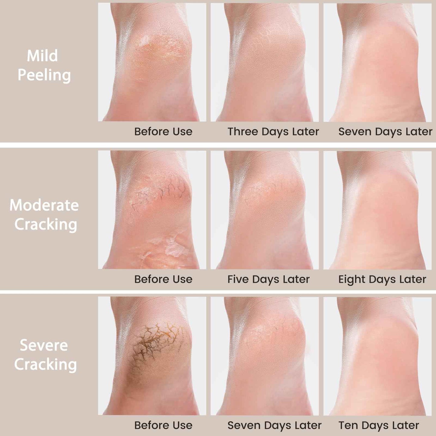 Mouriven 3 Packs Urea Cream 40 Percent - Foot & Hand Cream, for Dry, Cracked Heels, Feet, Knees, Elbows, and Hands, Callus Remover, Maximum Strength Urea Lotion for Softening and Moisturizing