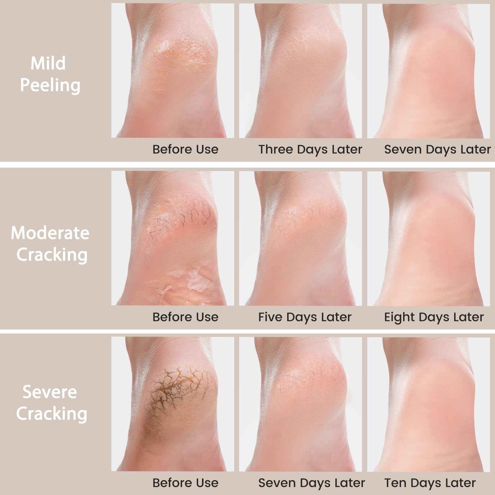 Mouriven 3 Packs Urea Cream 40 Percent - Foot & Hand Cream, for Dry, Cracked Heels, Feet, Knees, Elbows, and Hands, Callus Remover, Maximum Strength Urea Lotion for Softening and Moisturizing