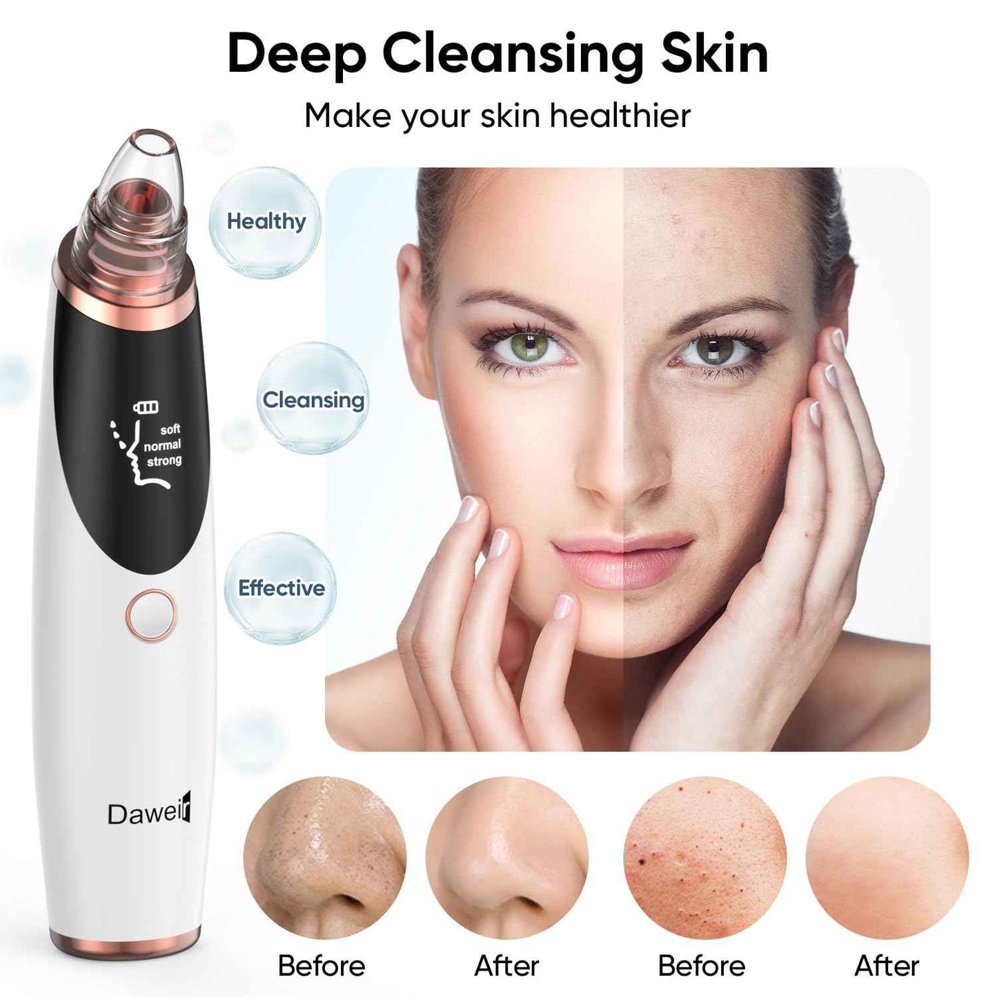 Blackhead Remover Pore Vacuum for Face & Nose – Deep Cleansing Blackhead Remover Tools with 3 Suction Levels, 5 Replaceable Tips, USB Rechargeable Pore Cleaner