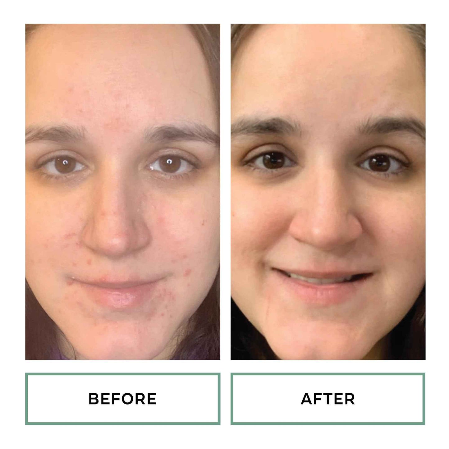 Replenix Gly-Sal Clarifying Acne Pads, 60 Count, Medical-Grade Glycolic Acid & 2% Salicylic Acid Exfoliating Pads for Acne-Prone Skin, Help Clear Blemishes & Refine Pores, Non-Oily