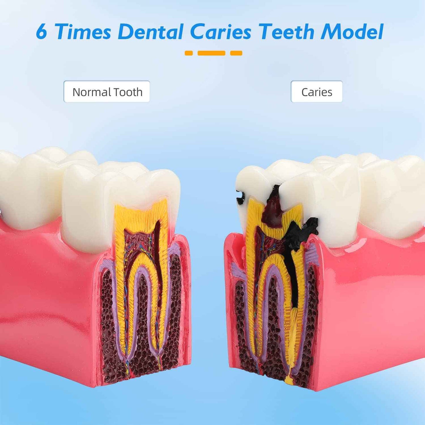 faruijie Dental Caries Tooth Model - 6 Times Caries Anatomy Dental Care Teeth Model Decay Teeth Comparative Education Model Dental Model Teaching for Patient Education