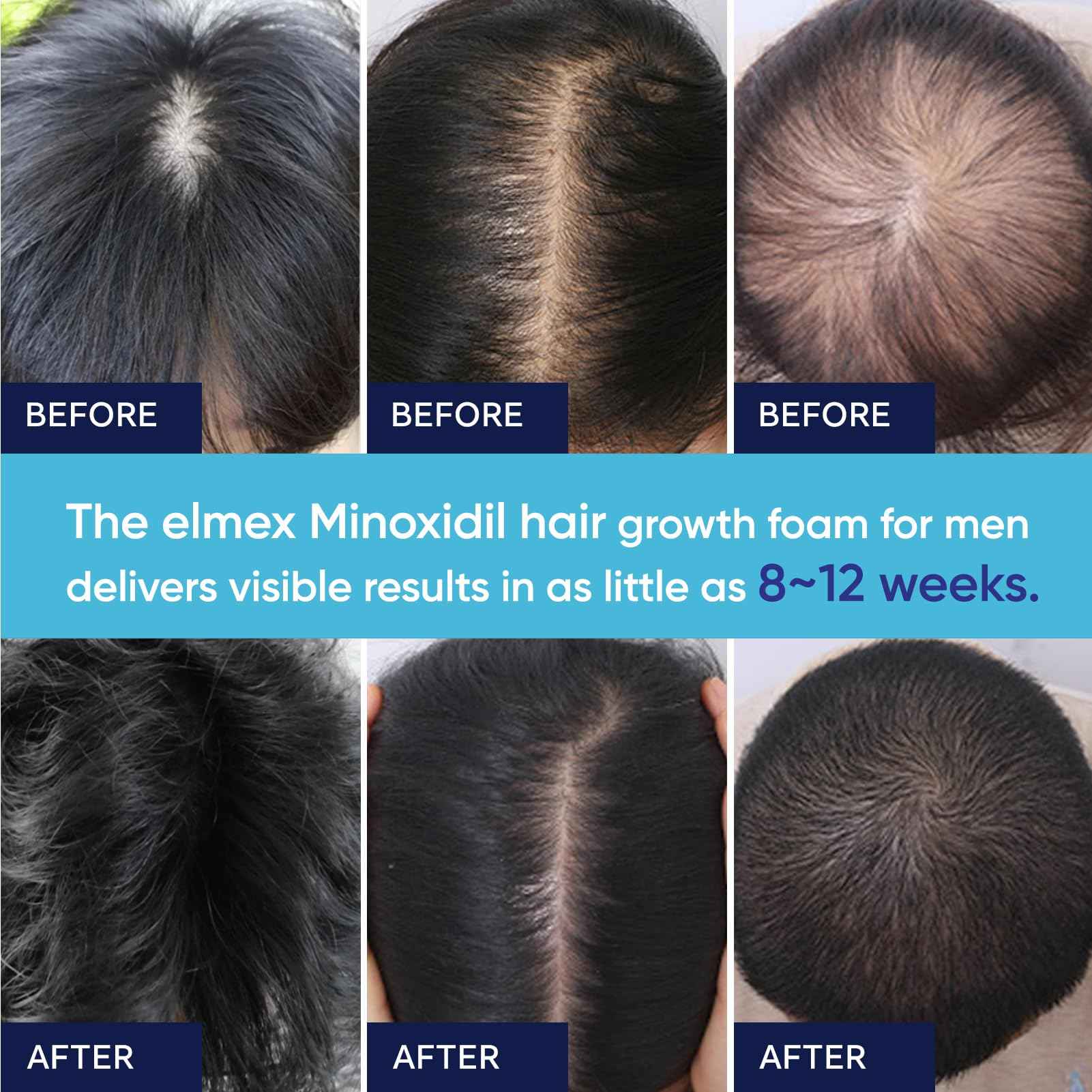 5% Minoxidil Foam for Men and Women, Minoxidil for Men Foam for Hair and Beard, Minoxidil for Women Hair Growth (6 Ounce)
