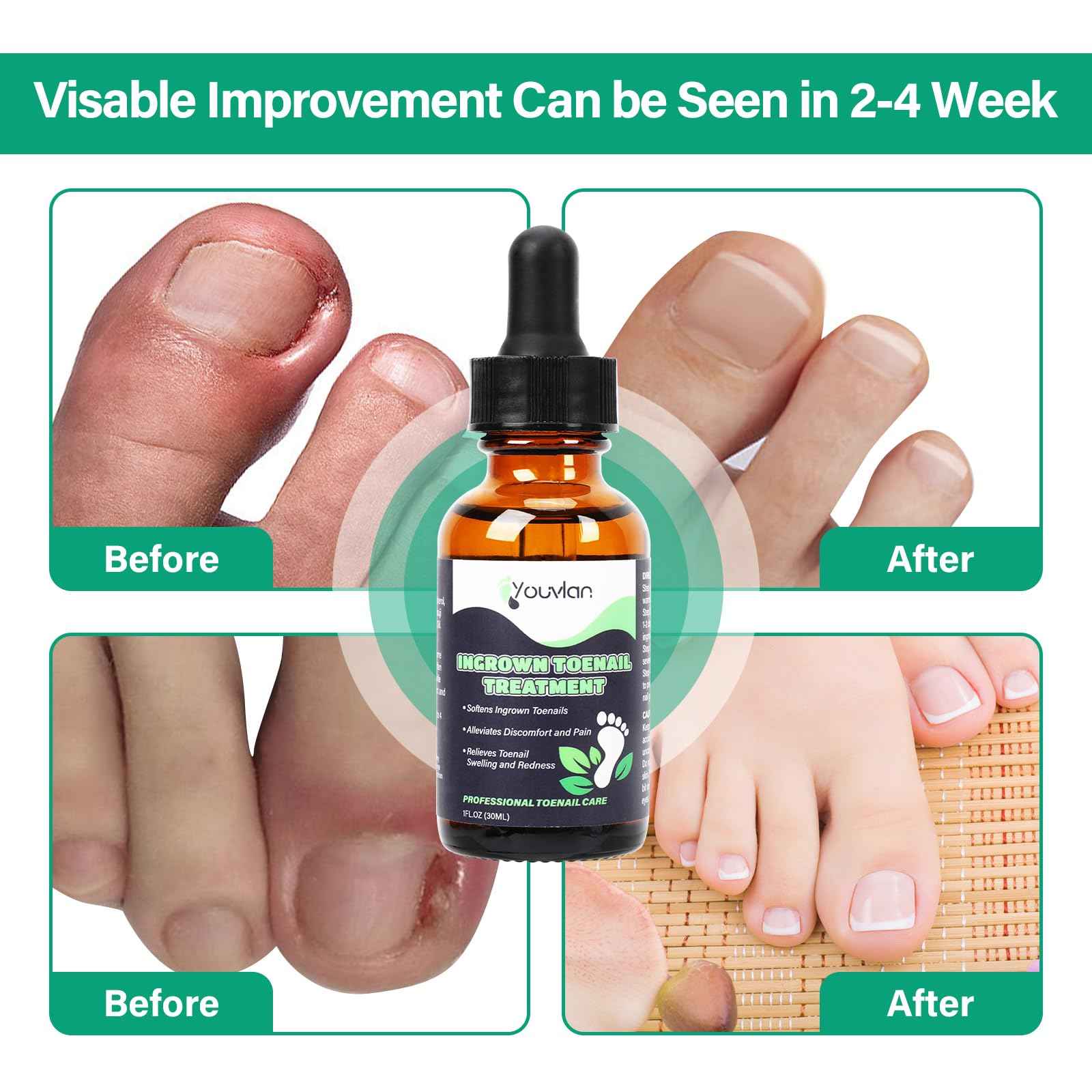 Ingrown Toenail Treatment - Ingrown Toenail Softener Drops,Toenail Lifter,Nail Patches,Best Ingrown Toenail Treatment Kit at Home for Easy Trim Thick Toe Nails Cleaner Tool Kit (Green)