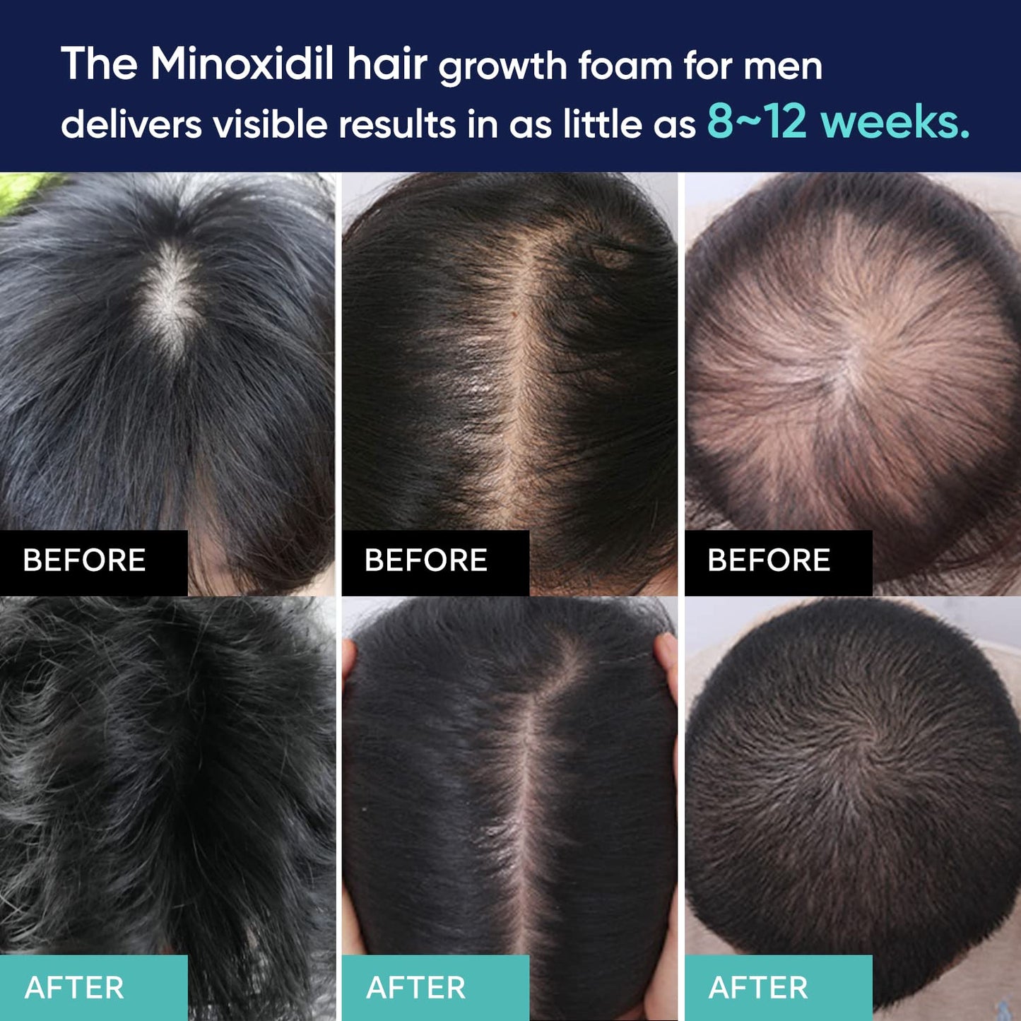 5% Minoxidil Foam for Men with Brush Minoxidil Hair Regrowth Treatment for Men Minoxidil & Biotin Helps Restore Thinning Hair & Reduce Hair Loss Treatments for Men 60g 1-Month supply