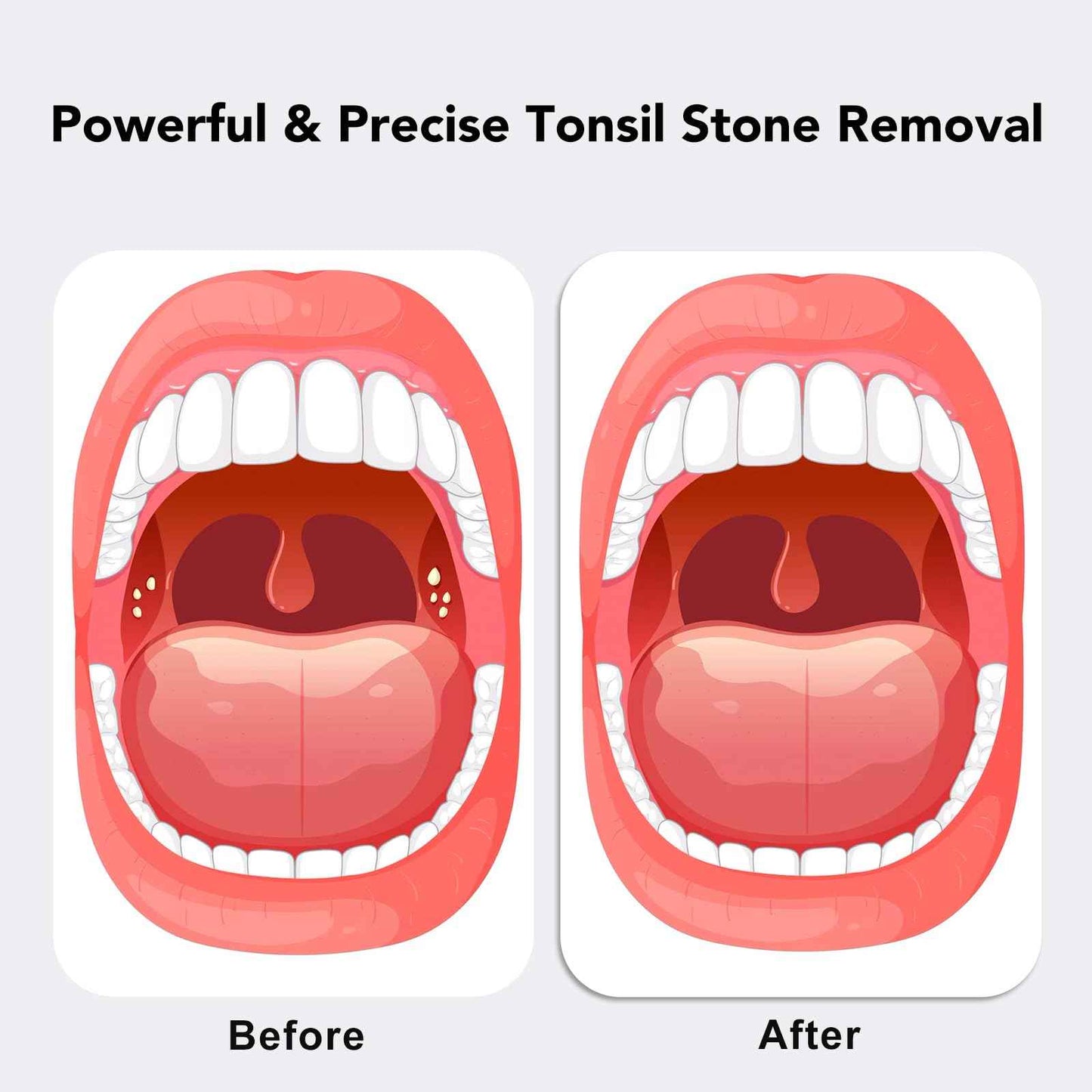 Upgraded Electric Tonsil Stone Remover – High-Precision & Painless Cleaning, Food-Grade Material, 6 Suction Levels | Tonsil Stone Removal Kit with LED Light, Oral Protection & 11 Attachments (Silver)