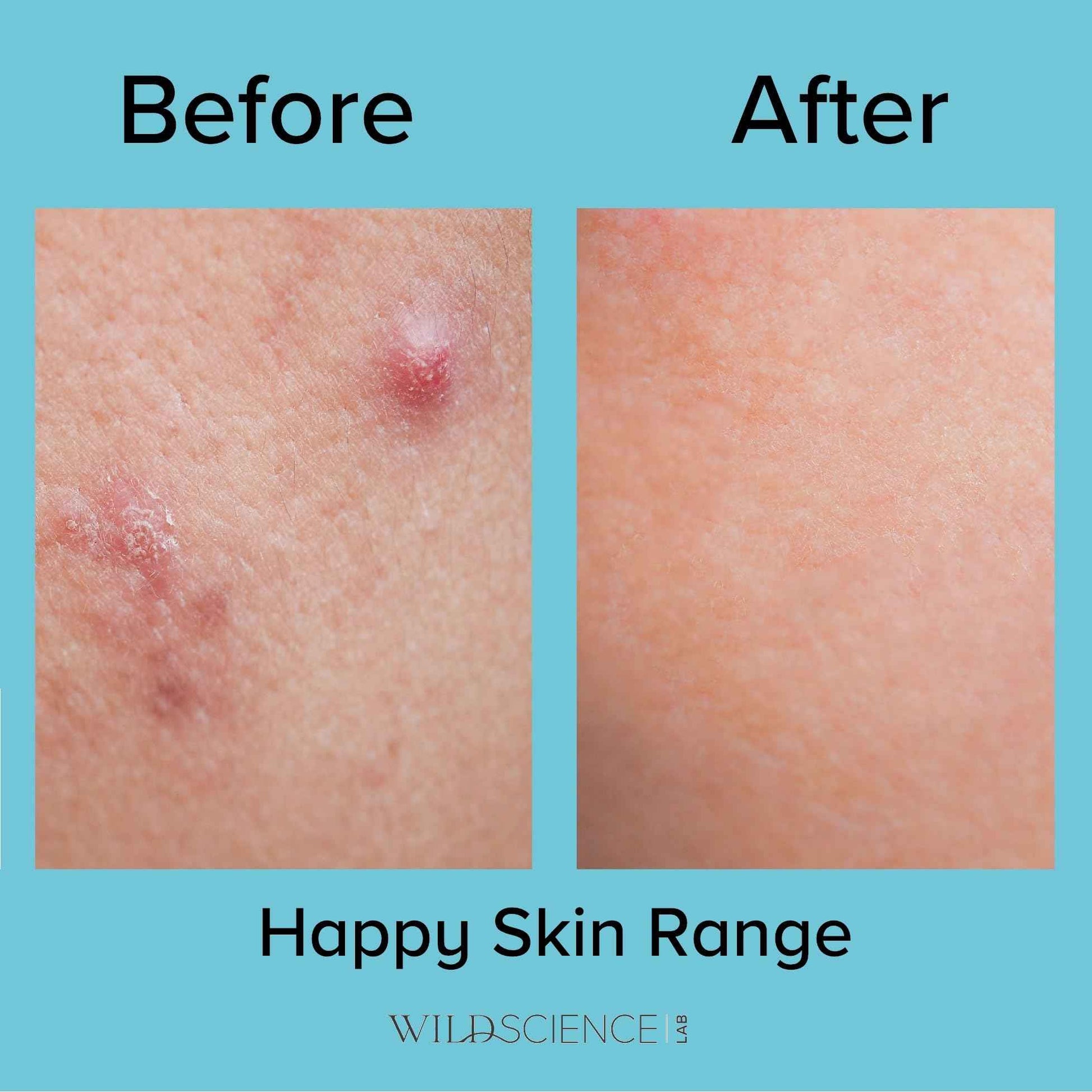 Wild Scicen Lab HAPPY BALANCE AHA + BHA + Zinc Clarifying Essence for Acne-Prone Skin