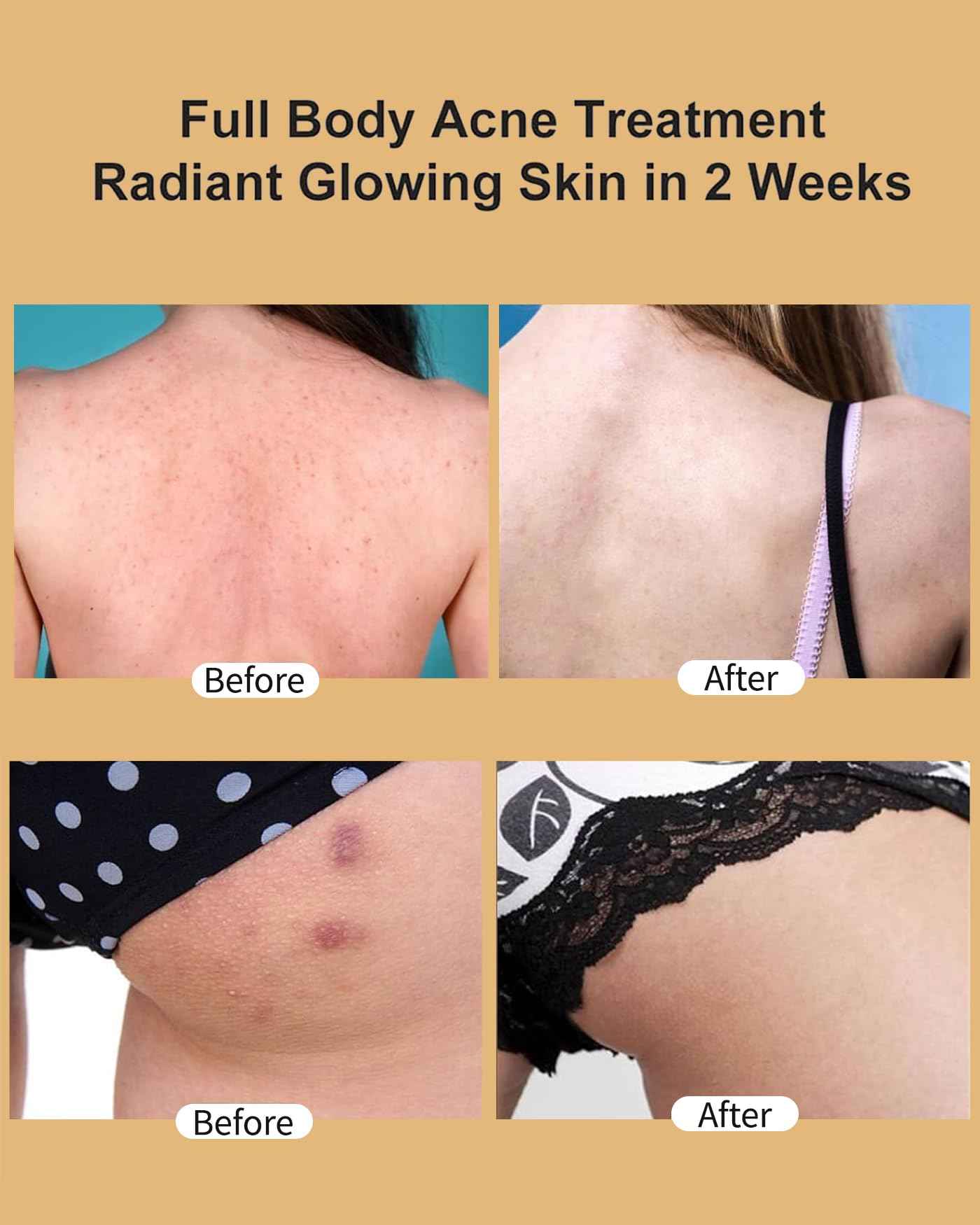 Butt Acne Clearing Treatment, Moisturizer Cream with 2% Salicylic Acid, Tea Tree Oil & Witch Hazel, Body Back Acne Treatment, Cystic Acne Treatment for Skin Delicate and Smooth 5.4oz