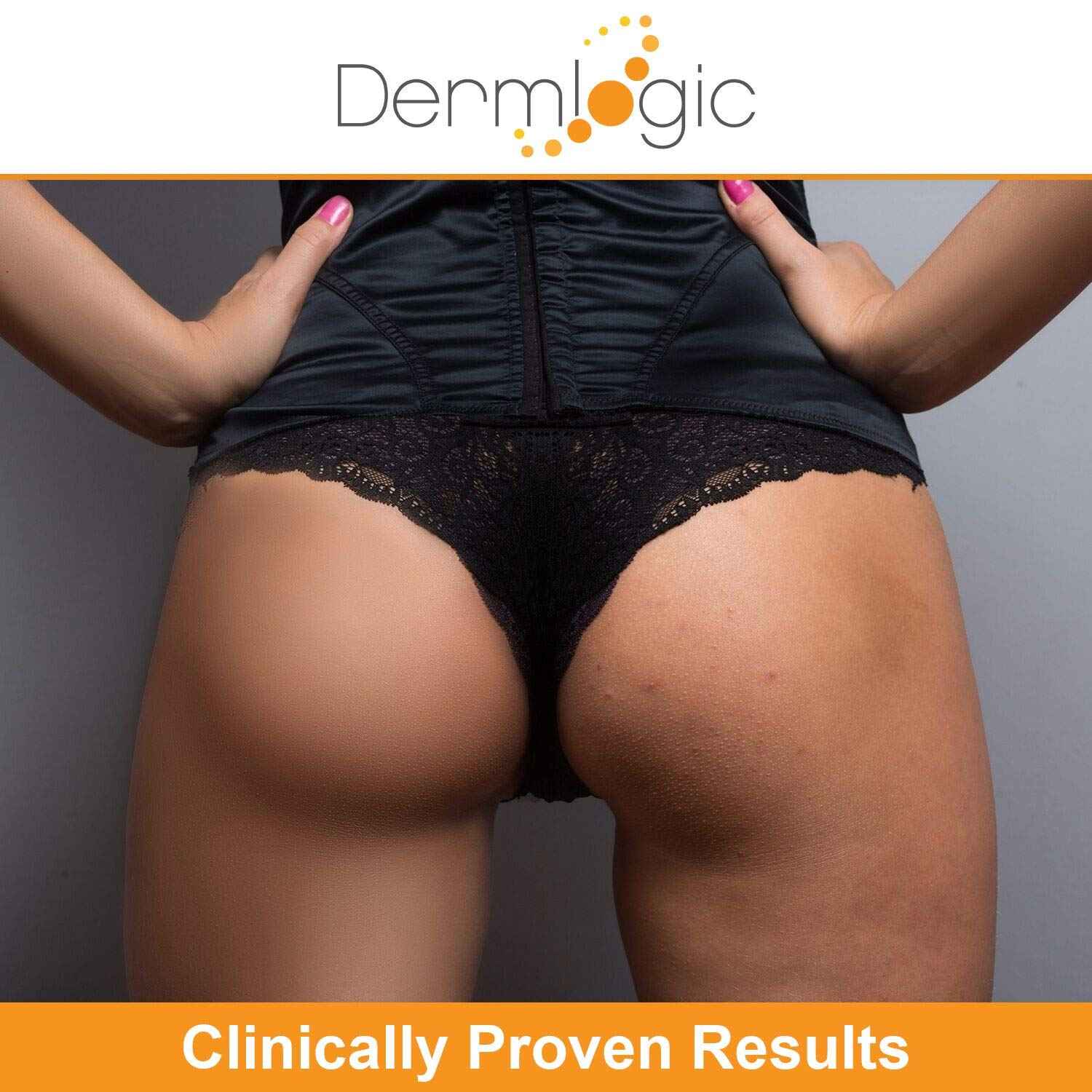 Anti-Acne Thigh & Buttocks Treatment - Clears Away Acne, Pimples, and Ingrown Hairs for the Buttocks and Thigh Area. Prevents Future Breakouts. 6.09 oz