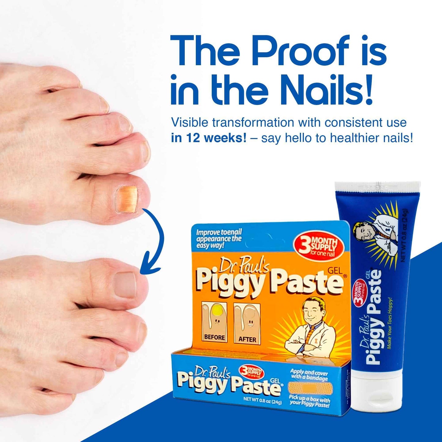 Dr. Paul's Piggy Paste Gel 2-Pack: Fast Acting Solution for Thick, Brittle, Yellow Nails, Restores Clear, Healthy Toenails & Fingernails Easy, Mess-Free Application Doctor Recommended Formula