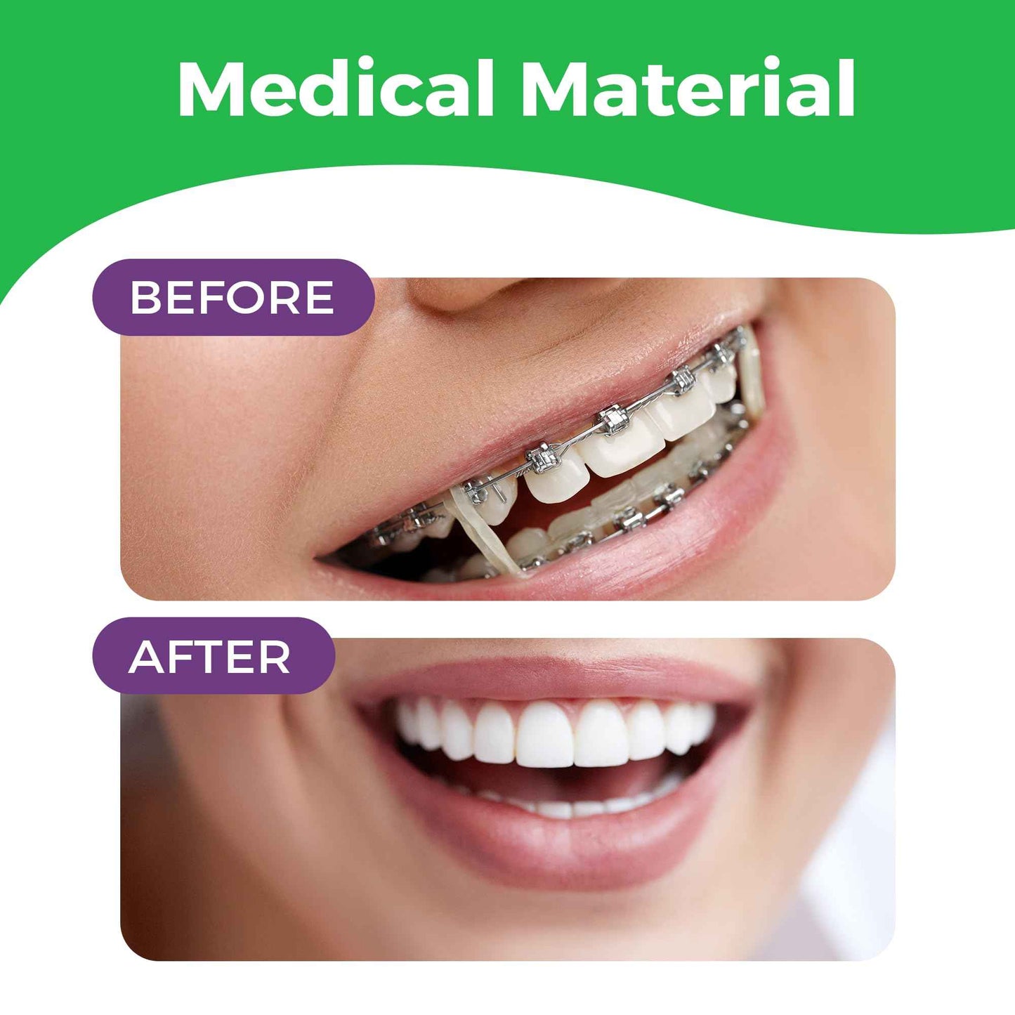 Orthodontic Rubber Bands for Braces - Premium Quality Elastic Teeth Rubber Bands for Braces, Fix Tooth Gaps, Dreadlocks, Includes Free Elastic Placer - Medium Force 3.5 oz, 1/8 Inch, Neon (500 Pack)