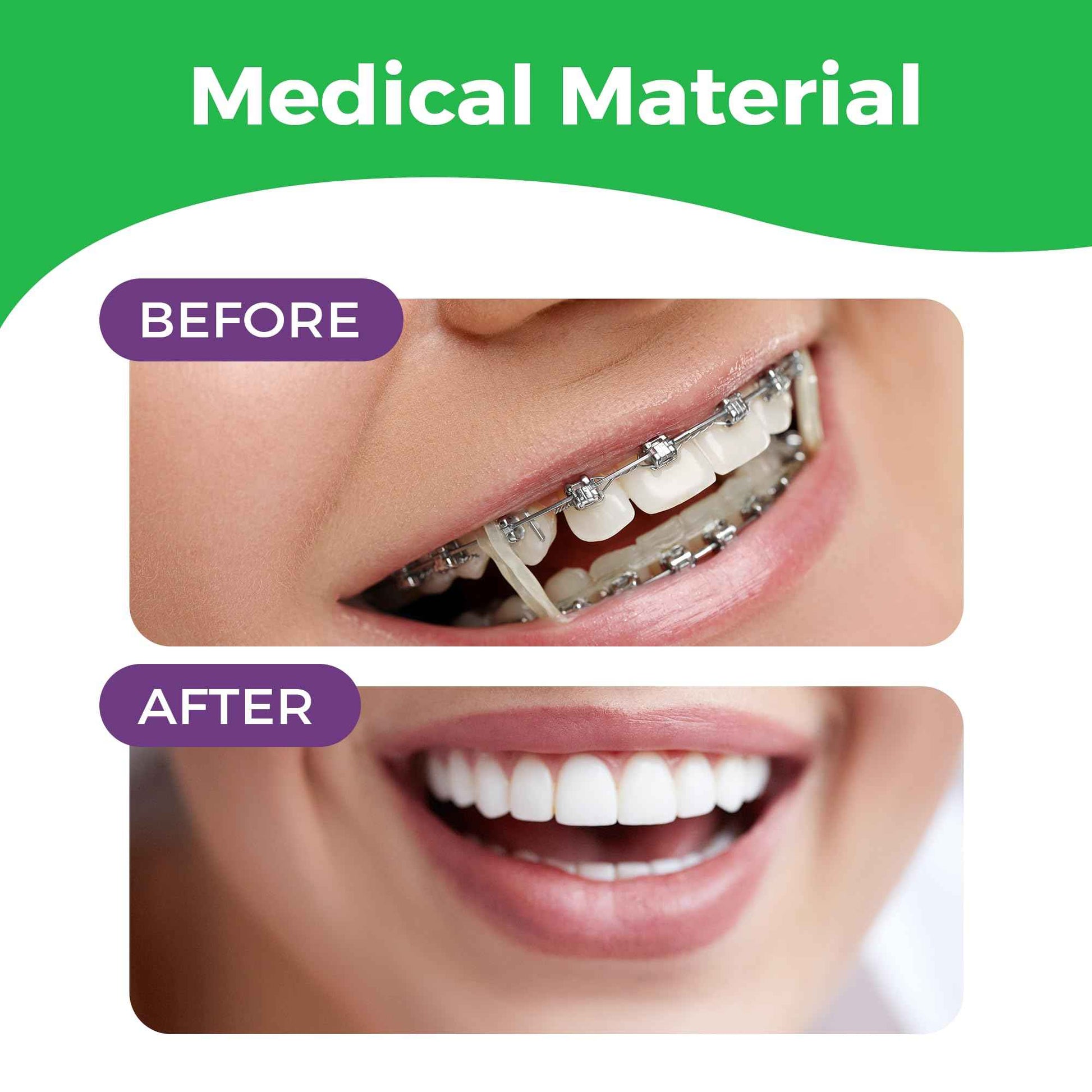 Orthodontic Rubber Bands for Braces - Premium Quality Elastic Teeth Rubber Bands for Braces, Fix Tooth Gaps, Dreadlocks, Includes Free Elastic Placer - Medium Force 3.5 oz, 1/8 Inch, Neon (500 Pack)