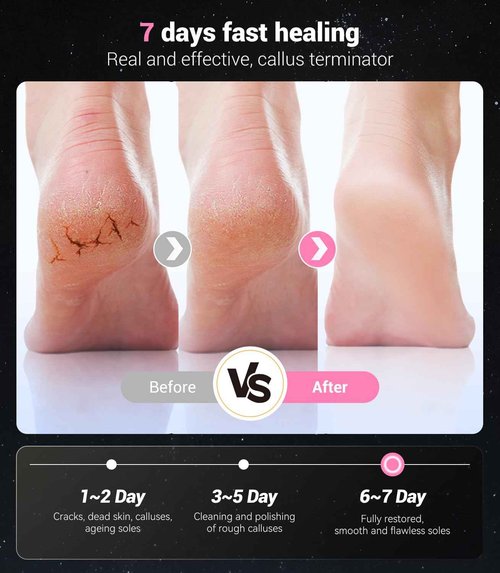 5-in-1 Professional Electric Callus Remover for Feet(Portable & Foldable), Removes 99.92% of Calluses in 3 Mins, Eectric Foot Callus Remover Pedicure Kits with 10 & 40 Grit Pads for Smooth Feet, Pink