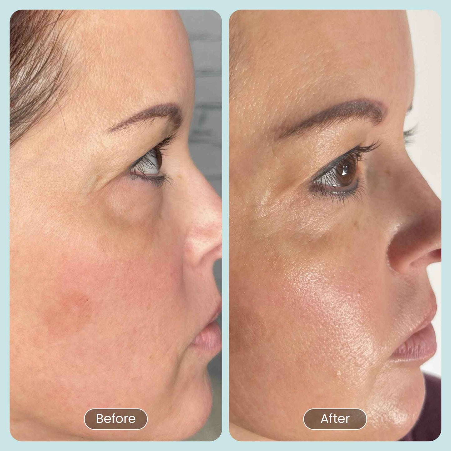 Beautiste 30 DAY MIRACLE BHA 20% Peeling Solution - Clinical Strength BHA Liquid Exfoliant for Clogged Pores, Wrinkles & Blackhead Remover - Salicylic Acid Serum & Chemical Exfoliant for Face Peel 1oz