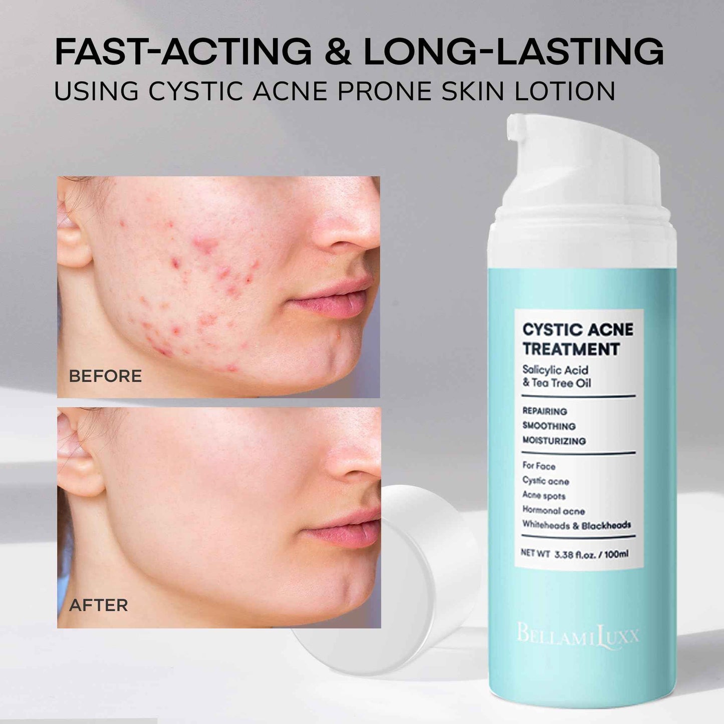BellamiLuxx Cystic Acne Treatment for Face: Hormonal Acne Treatment Cream for Teens & Adults - Salicylic Acid & Tea Tree Oil Pimple Spot Remover - Anti-Acne Moisturizer Reduces Redness, Blemishes