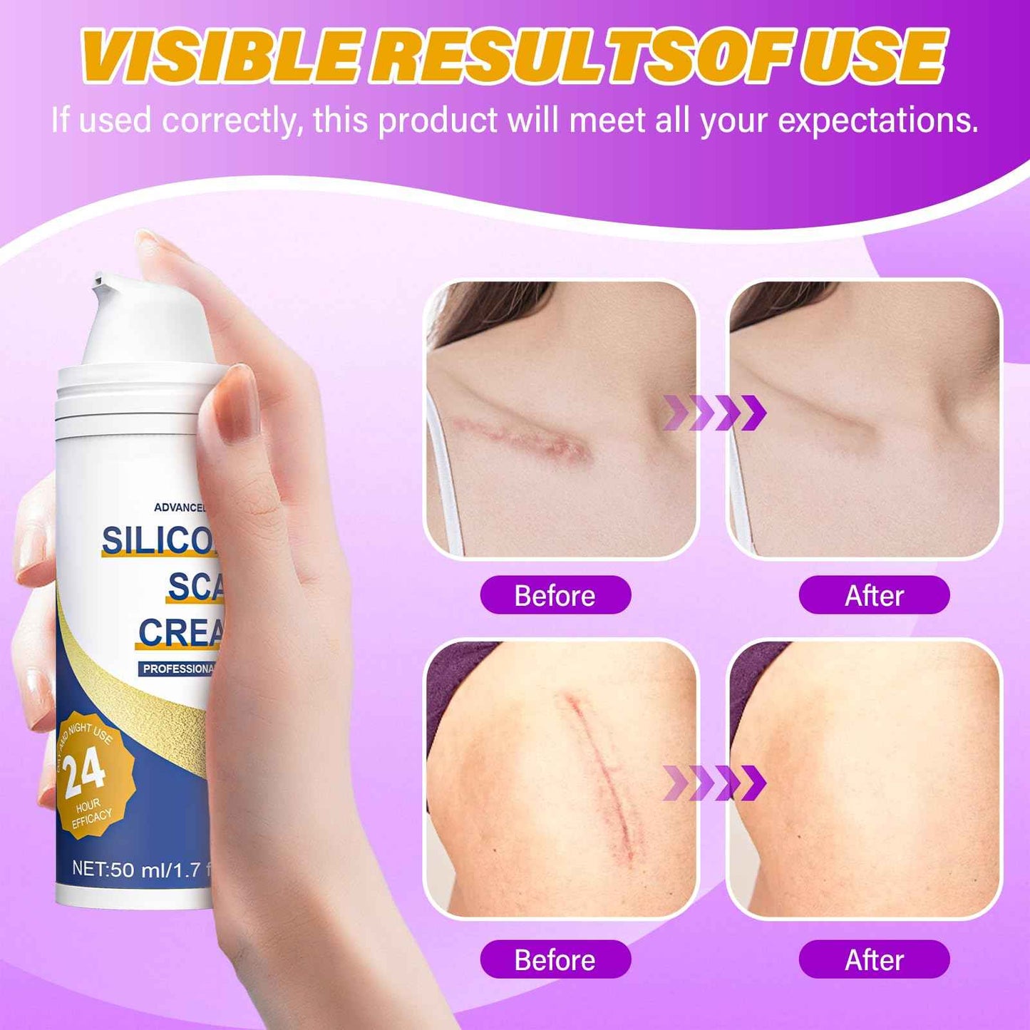 Scar Cream,Silicone Scar Gel,Advanced Scar Gel,Scar Removal Cream For Surgical Scars,Burn,Acne,Stretch Mark,Keloid Bump,C Section Scars 1.7 oz(50g)
