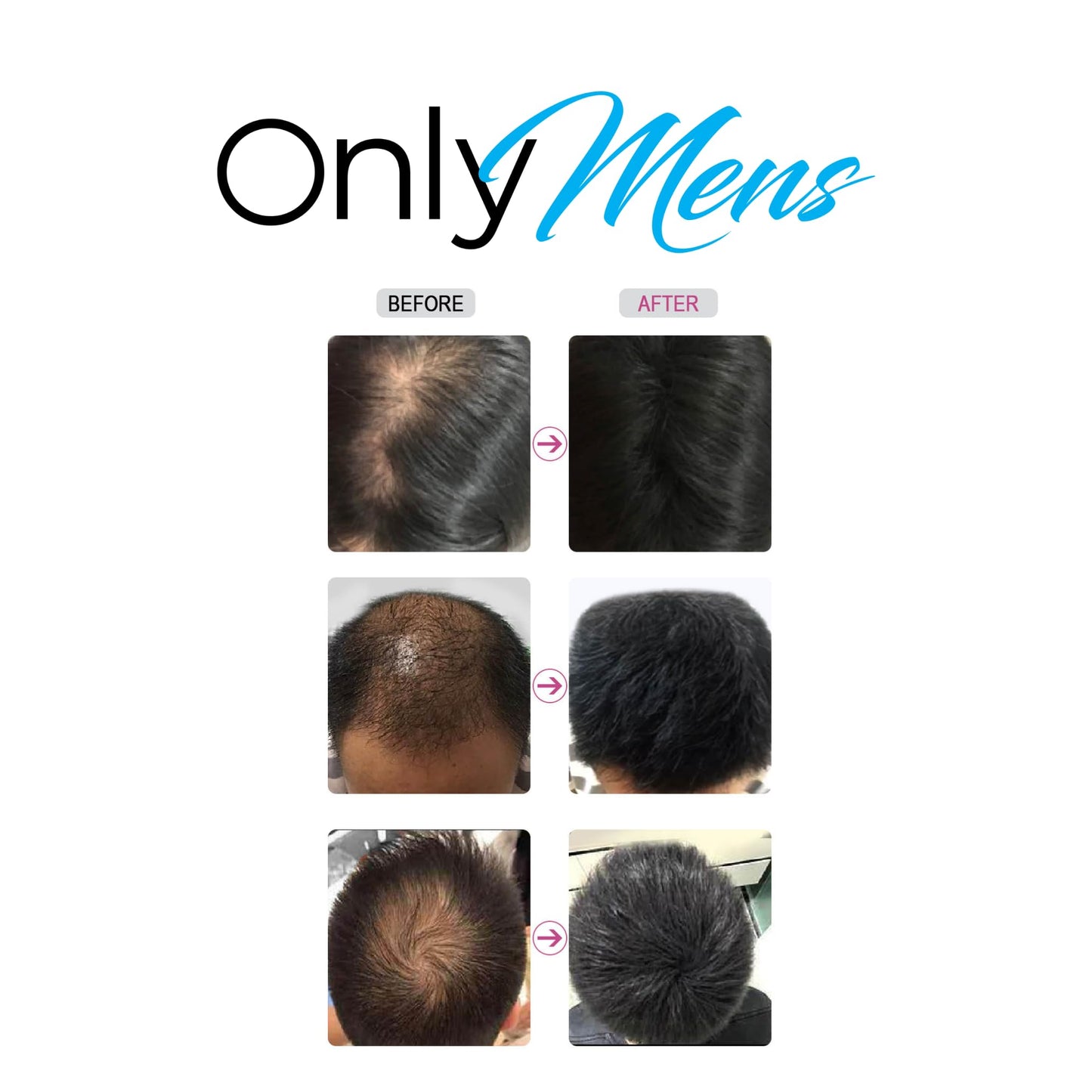 OnlyMens Hair Building Powder Fibers | Black 25g | 0.88oz Hair Powder for Thinning Hair - Fuller Looking Hair Instantly