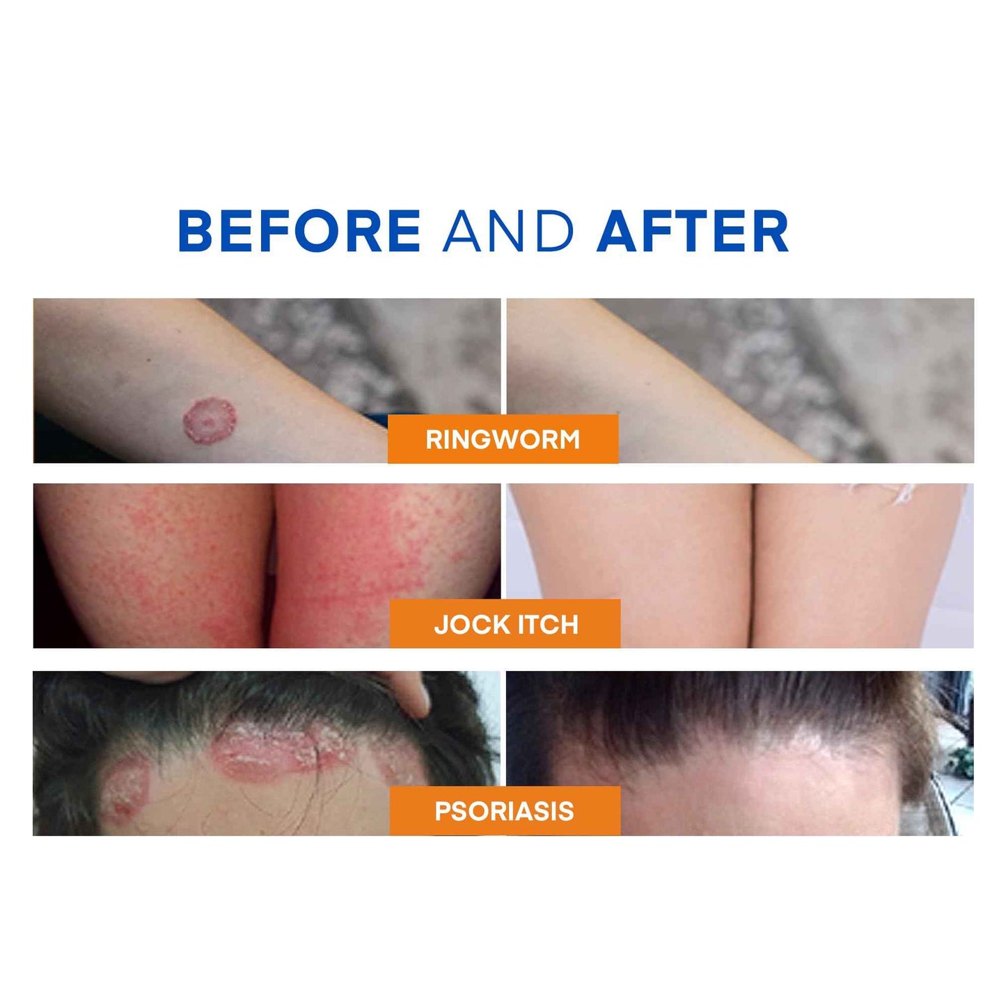 Hermon Ringworm Treatment Anti-fungal Kit - RingWorm Treatment for Humans 3.52 oz cream 4 oz soap bar for Ringworm, Athlete's Foot, Jock Itch, Eczema, Tinea - for Adults and Kids