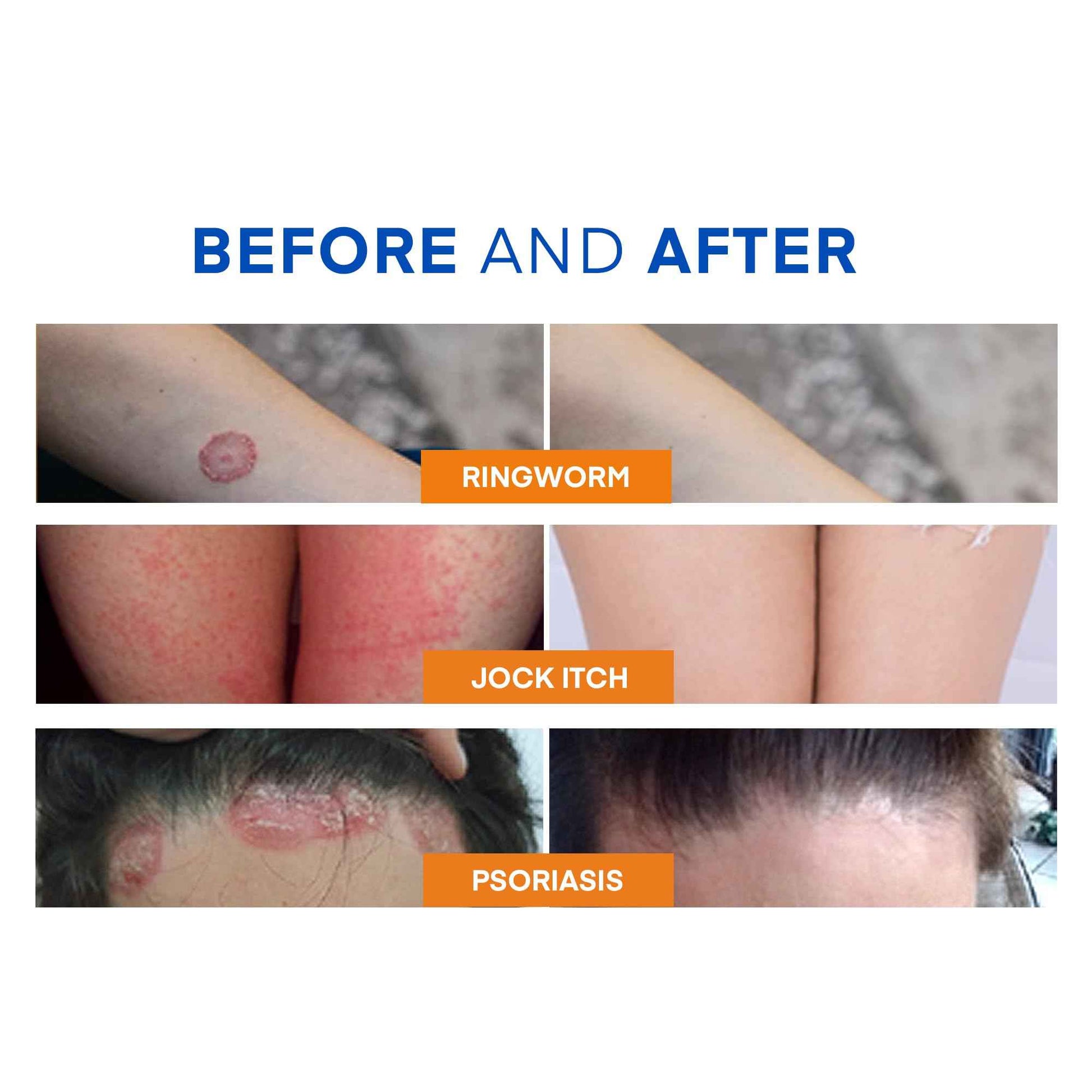 Hermon Ringworm Treatment Anti-fungal Kit - RingWorm Treatment for Humans 3.52 oz cream 4 oz soap bar for Ringworm, Athlete's Foot, Jock Itch, Eczema, Tinea - for Adults and Kids