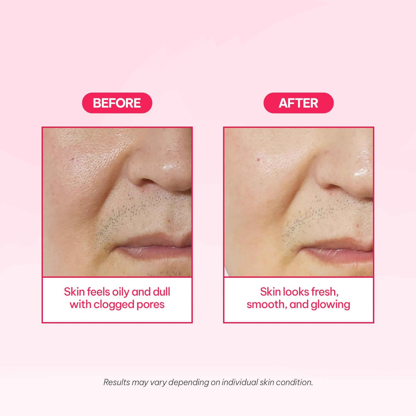 Millford AC Bubbly Bubbly Wash-Off Pack 125g/4.4Oz, Kaolin, Deep Cleansing, Acne Prone Skin, Bubble Wash, Exfoliating, Bubble Mask, Removing Sebum and Dead Skins, Instant Bubbles Pop up