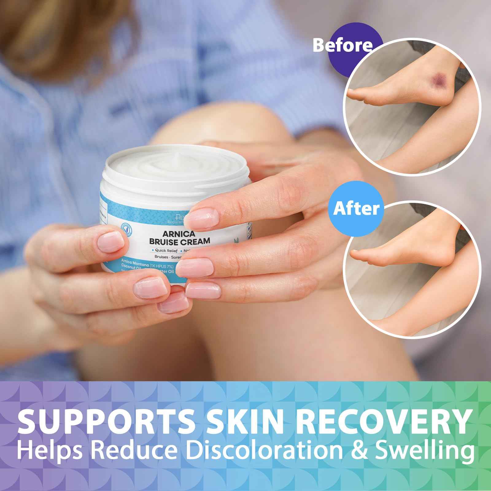 Arnica Bruise Cream Extra Strength: Rapid Relief for Bruising Swelling Soreness Pain on Thin Skin - Potent Arnica Montana with Vitamin K Coconut Shea Butter - Face & Body