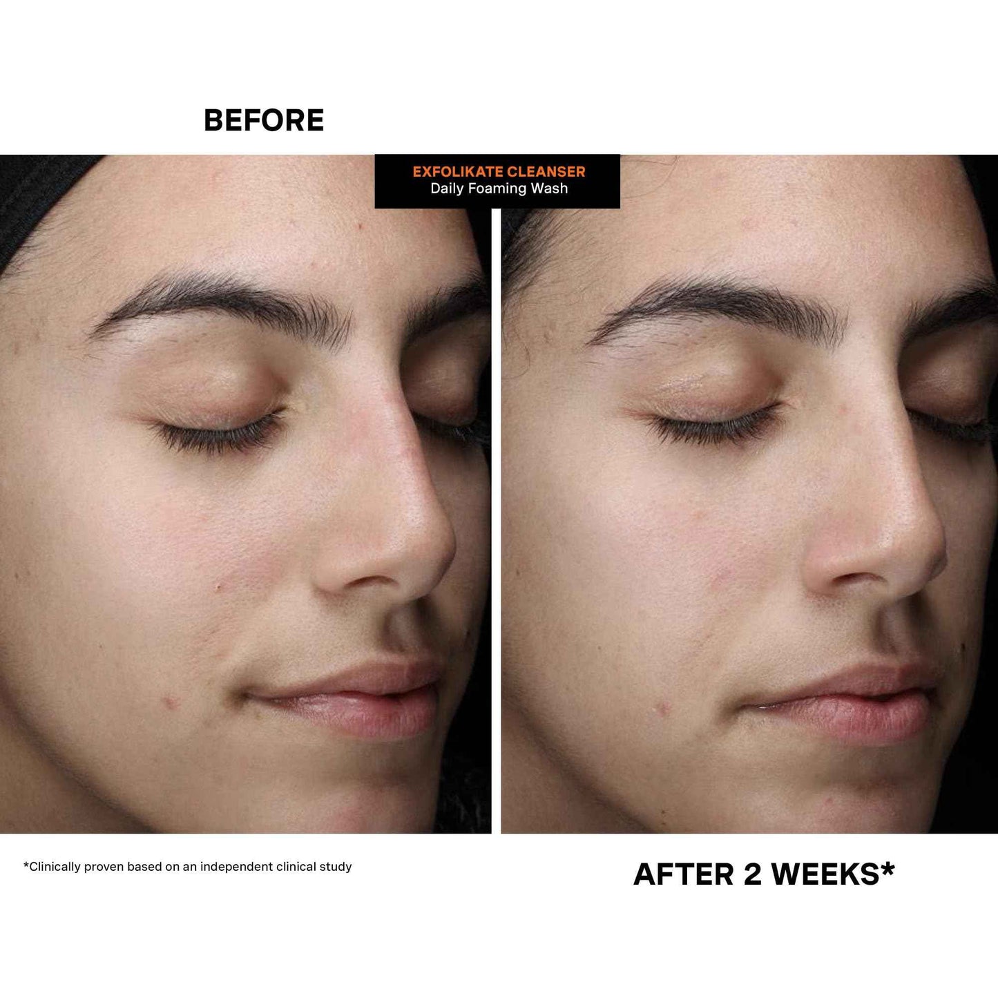 Kate Somerville ExfoliKate Cleanser – Daily Exfoliating Foaming Face Wash, Clinically Formulated Glycolic Acid and Lactic Acid Gentle Facial Scrub, 4 Fl Oz