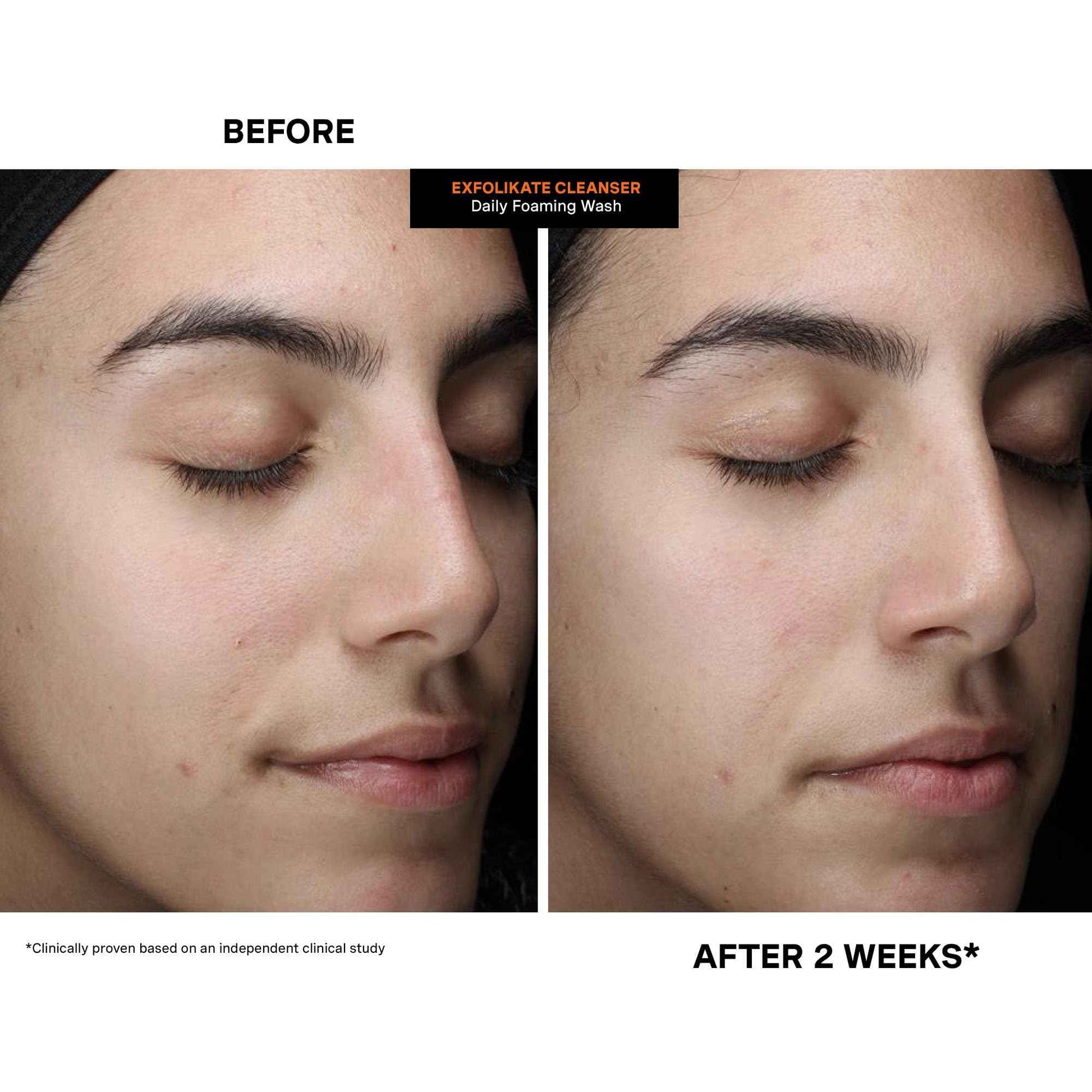 Kate Somerville ExfoliKate Cleanser – Daily Exfoliating Foaming Face Wash, Clinically Formulated Glycolic Acid and Lactic Acid Gentle Facial Scrub, 4 Fl Oz