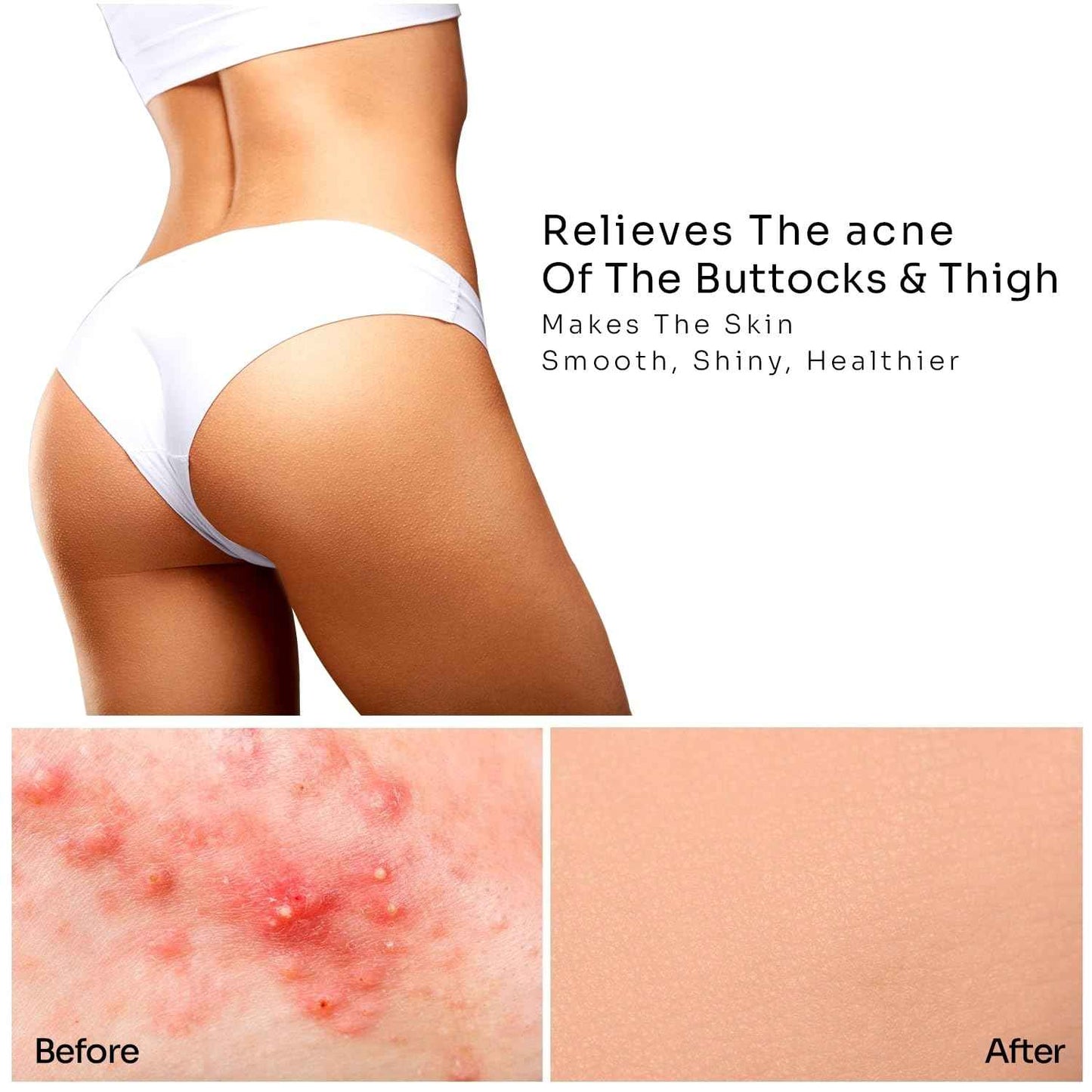 Anti-Acne Thigh & Buttocks Treatment - Clears Away Acne, Pimples, and Ingrown Hairs for the Buttocks and Thigh Area. Prevents Future Breakouts. 6.09 oz